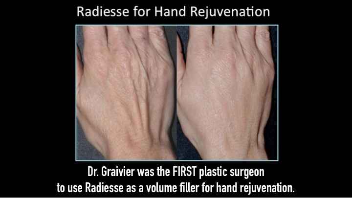 Radiesse For Hands Before After | The Graivier Center in Alpharetta, GA