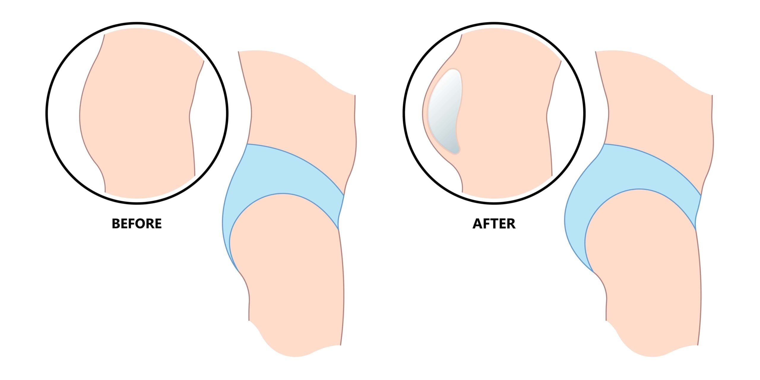 The Art of Natural Enhancement Exploring the Beauty of Fat Grafting