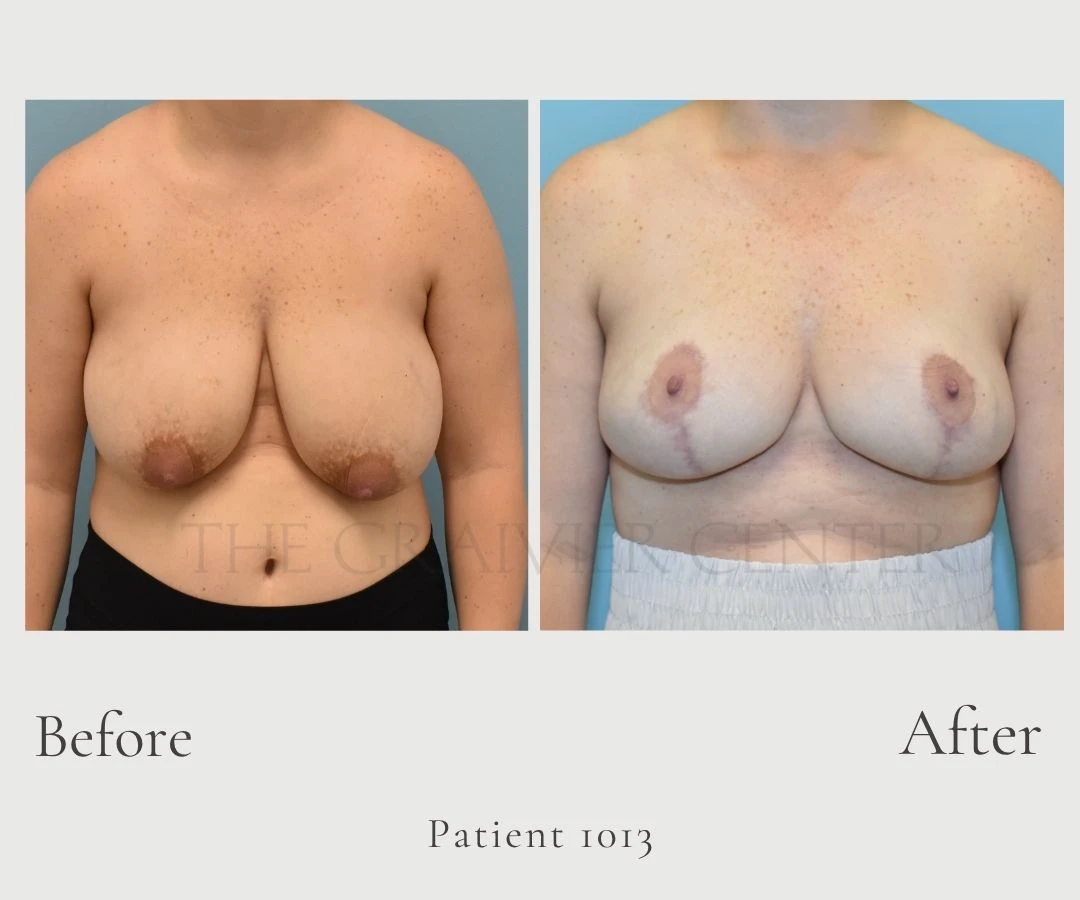 Case 1013 Breast Reduction without lipo 1