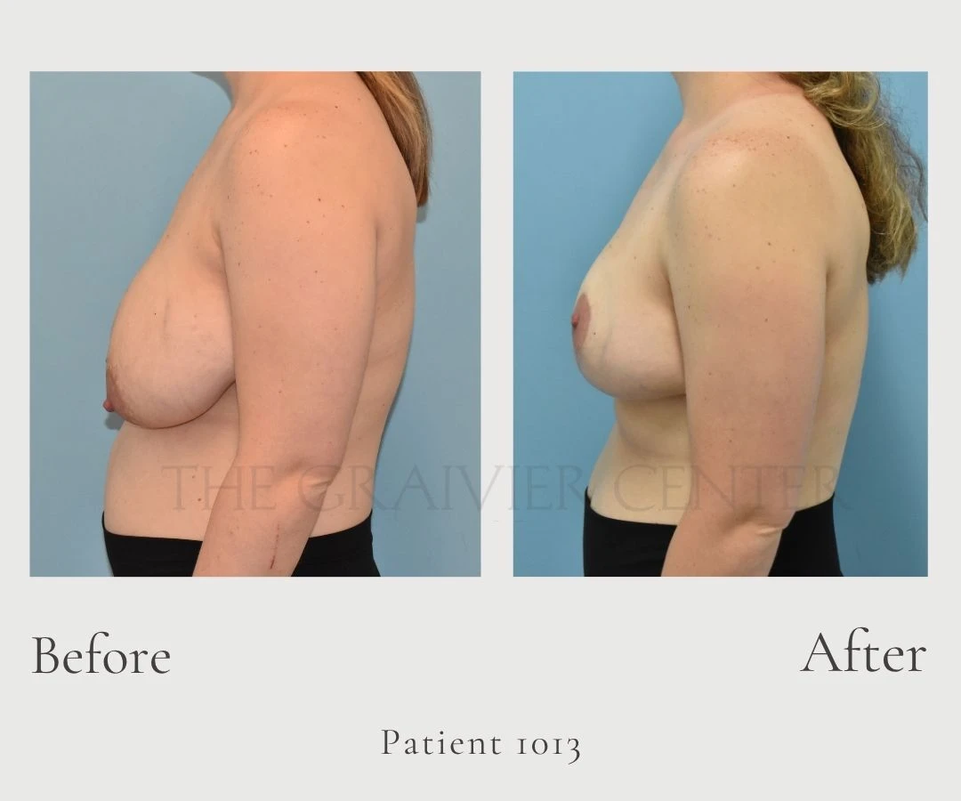 Case 1013 Breast Reduction without lipo 2