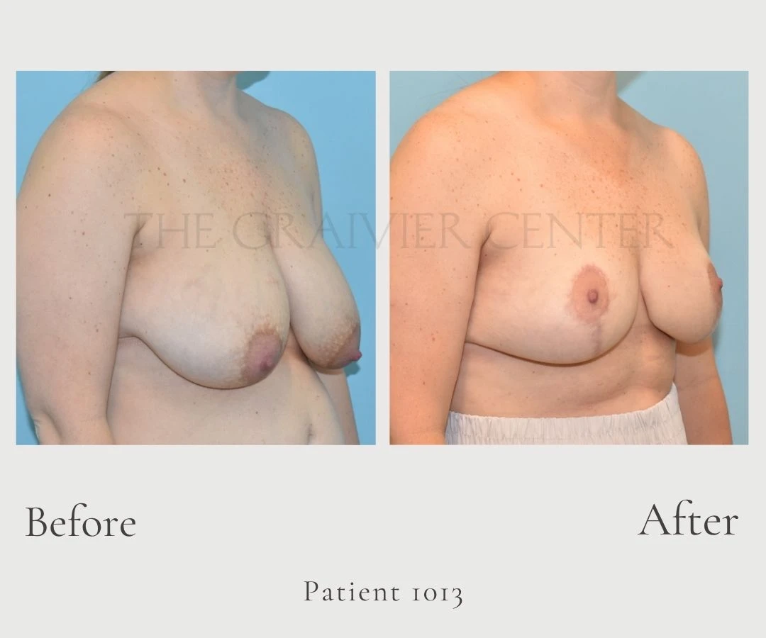Case 1013 Breast Reduction without lipo 3
