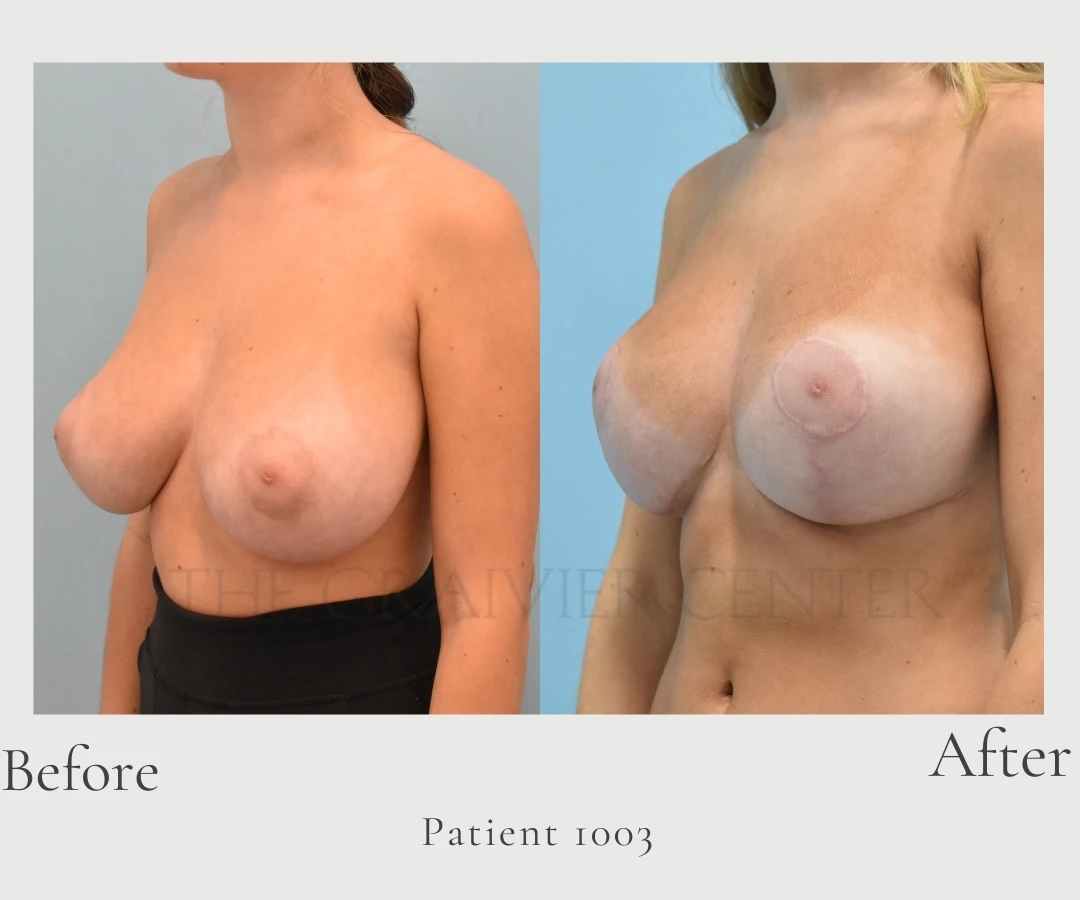 Breast Reduction before and after photos at The Graivier Center in Alpharetta GA