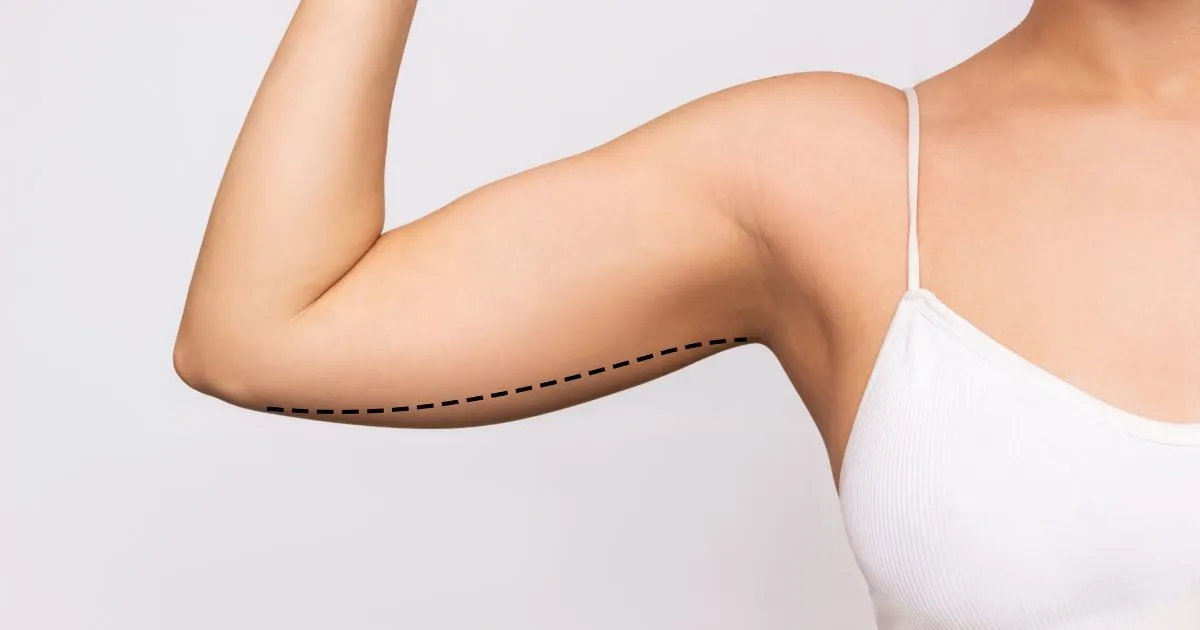 Woman showing arm with dotted line for Arm Lift procedure in Alpharetta, GA