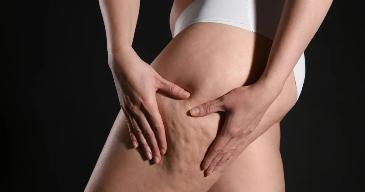 Thigh cellulite appearance before cellulite reduction treatment in Alpharetta, GA