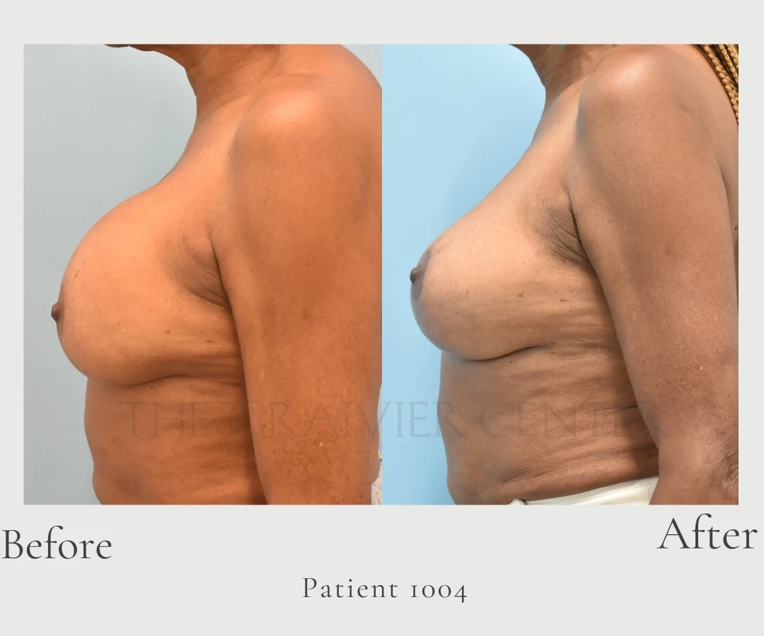 Case 1004 Bilateral Implant Exchange, bilateral mastopexy right