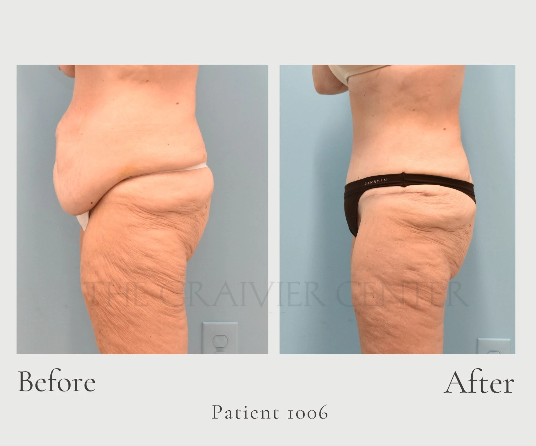 Case 1006 Abdominoplasty with Lipo Hill
