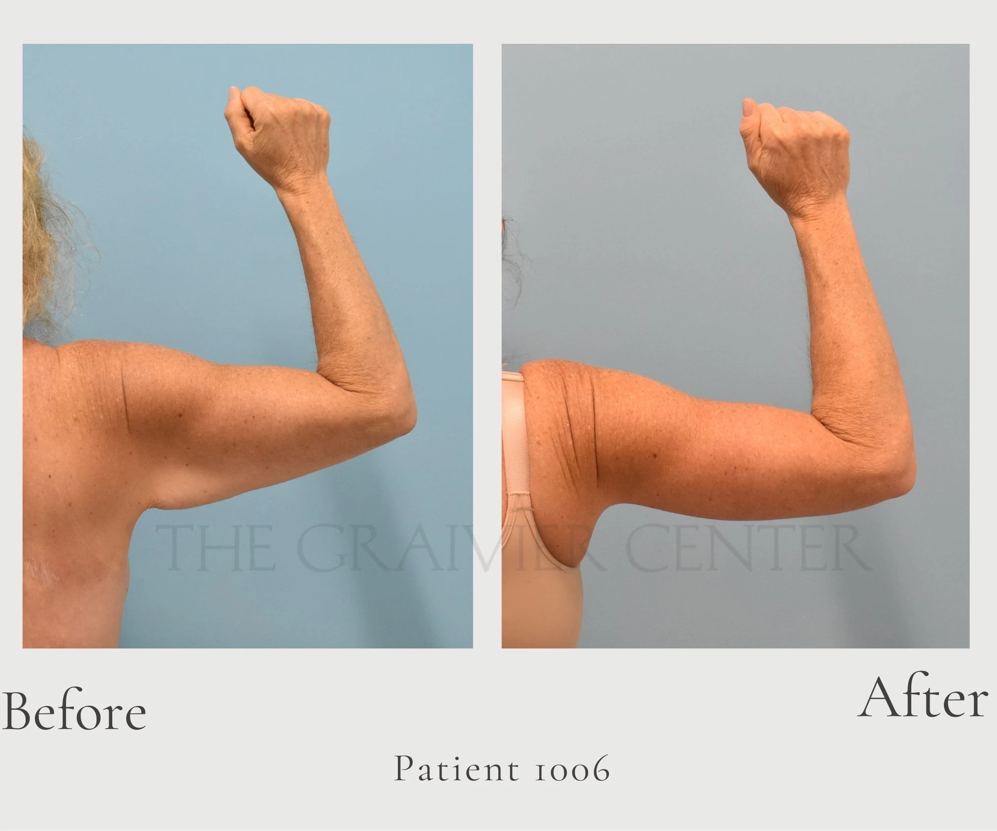Case 1006 Brachioplasty back right hill