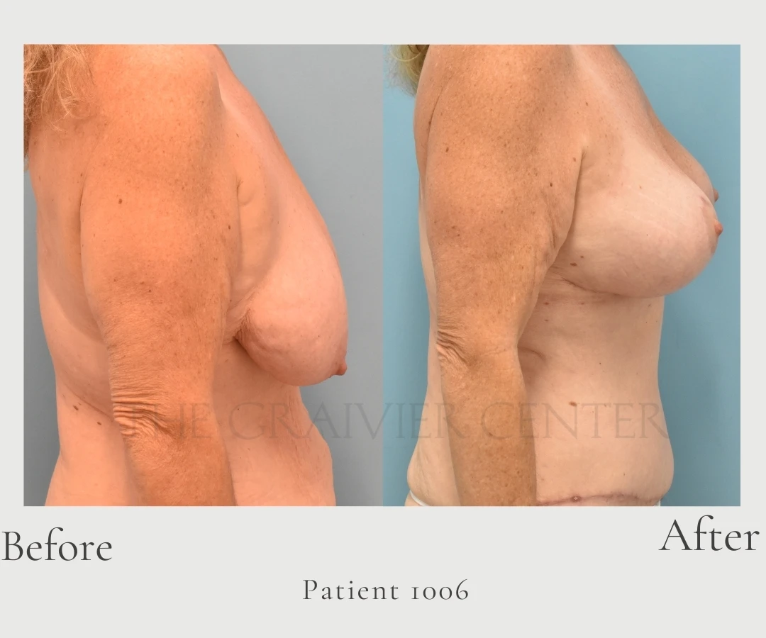 Case 1006 Breast lift with gel implants, liposuction to axillas and outer chest left