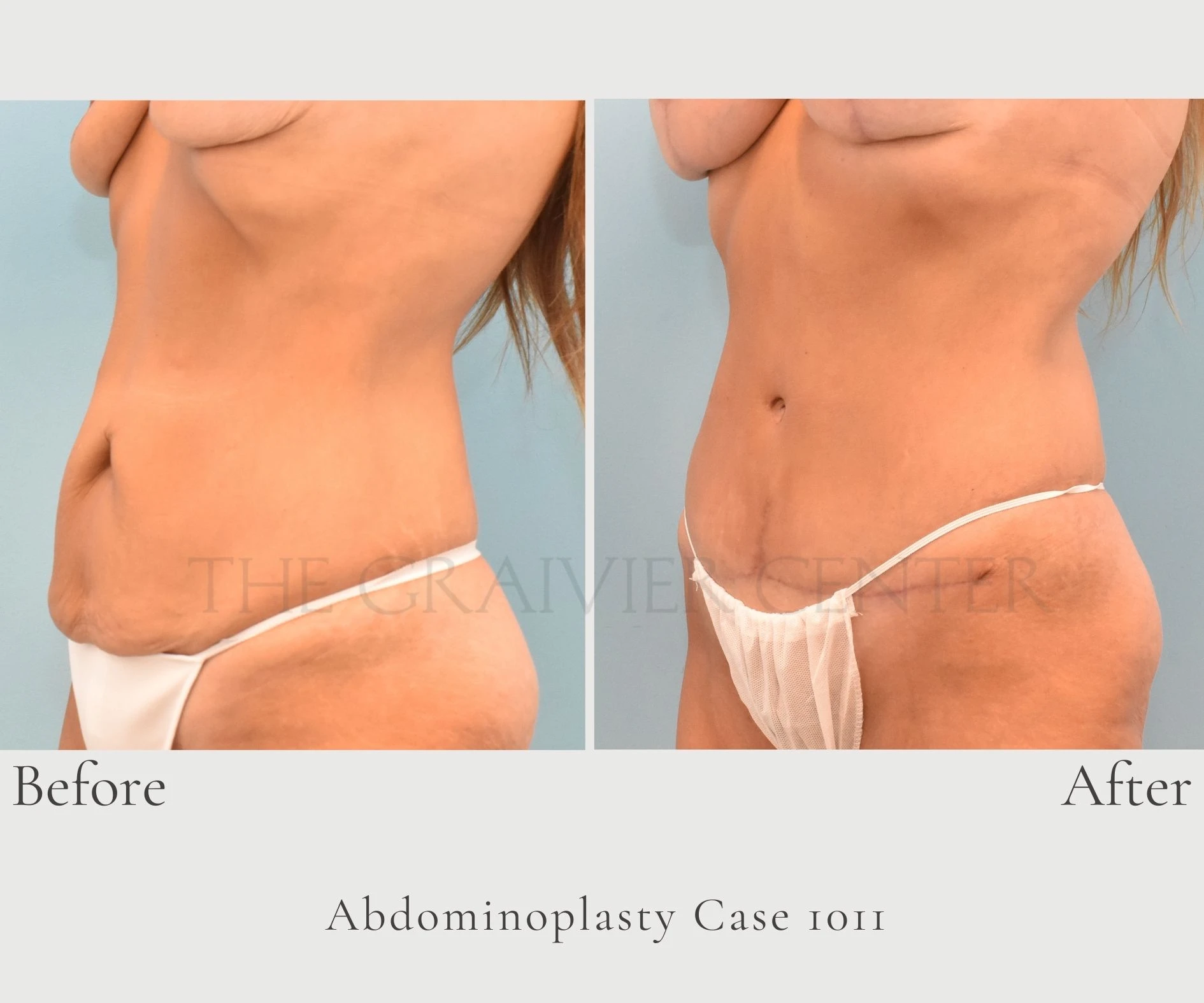 Case 1011 Abdominoplasty with lipo Dr. Graivier 1
