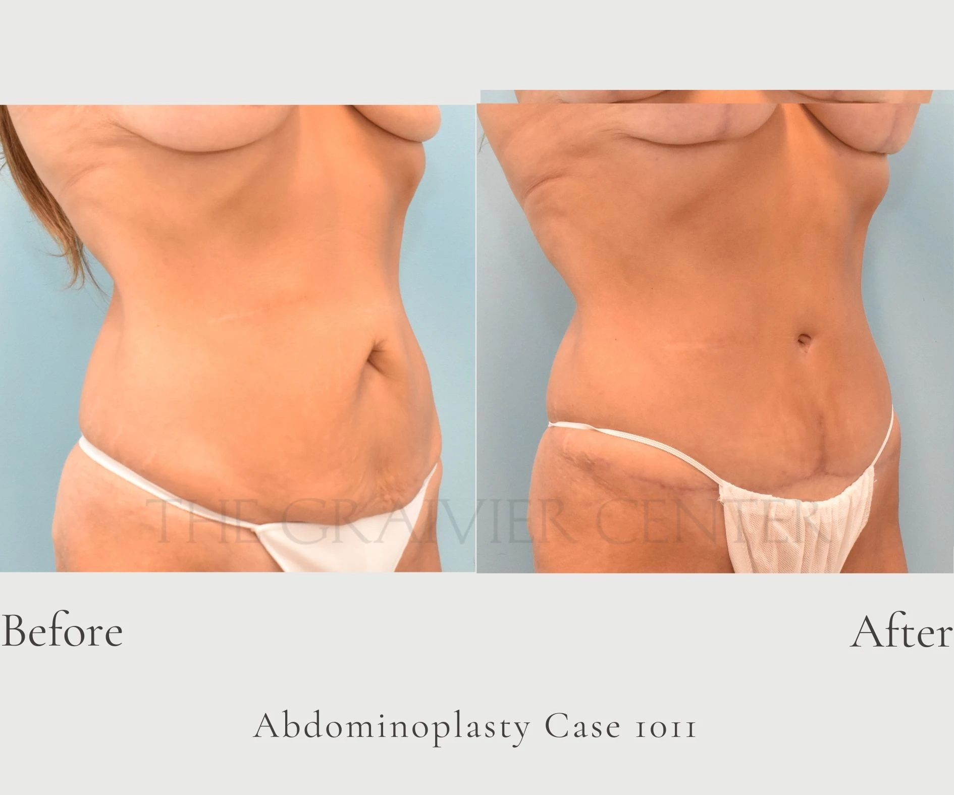 Case 1011 Abdominoplasty with lipo Dr. Graivier 3