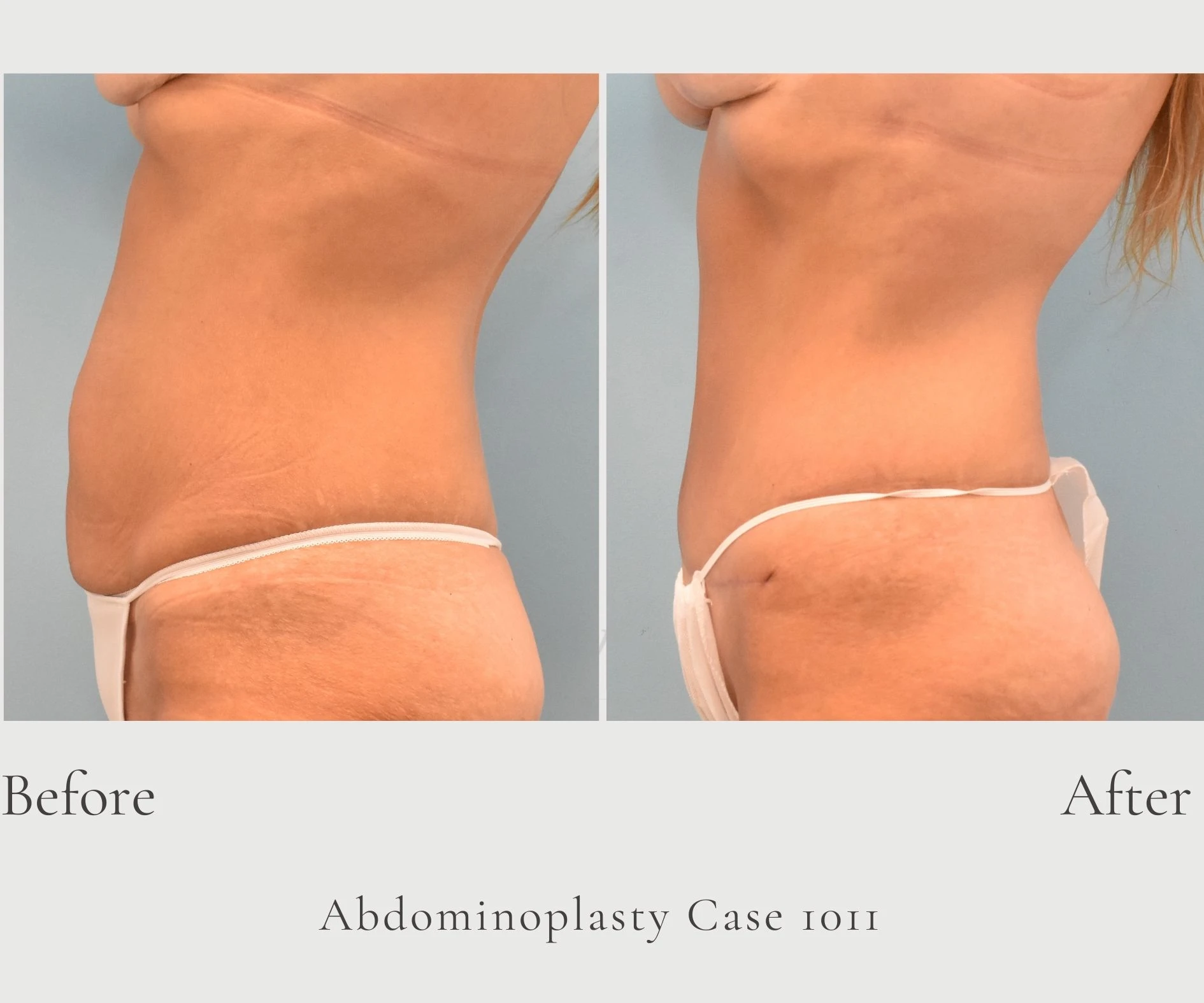 Case 1011 Abdominoplasty with lipo Dr. Graivier 4