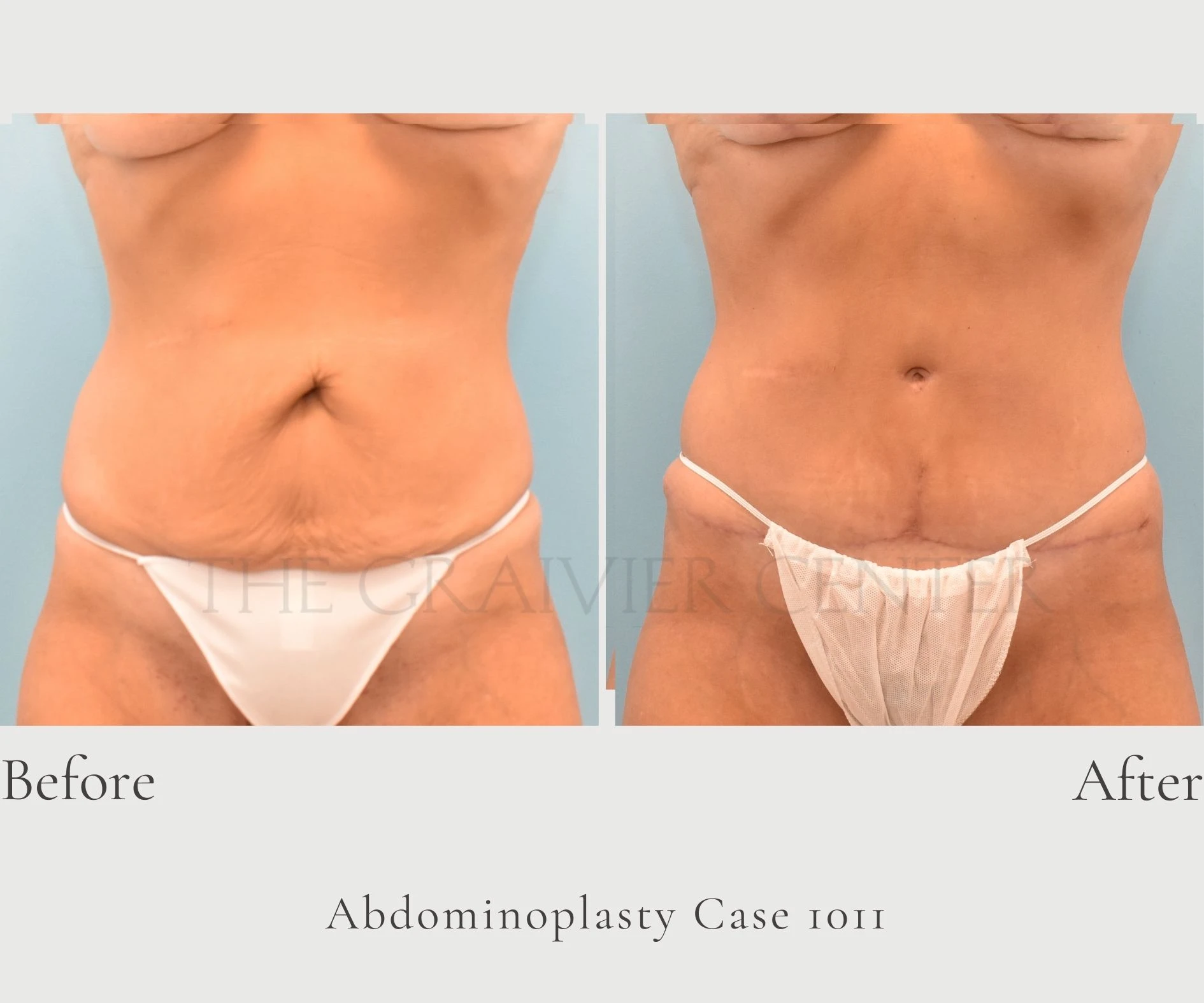 Case 1011 Abdominoplasty with lipo Dr. Graivier Front View