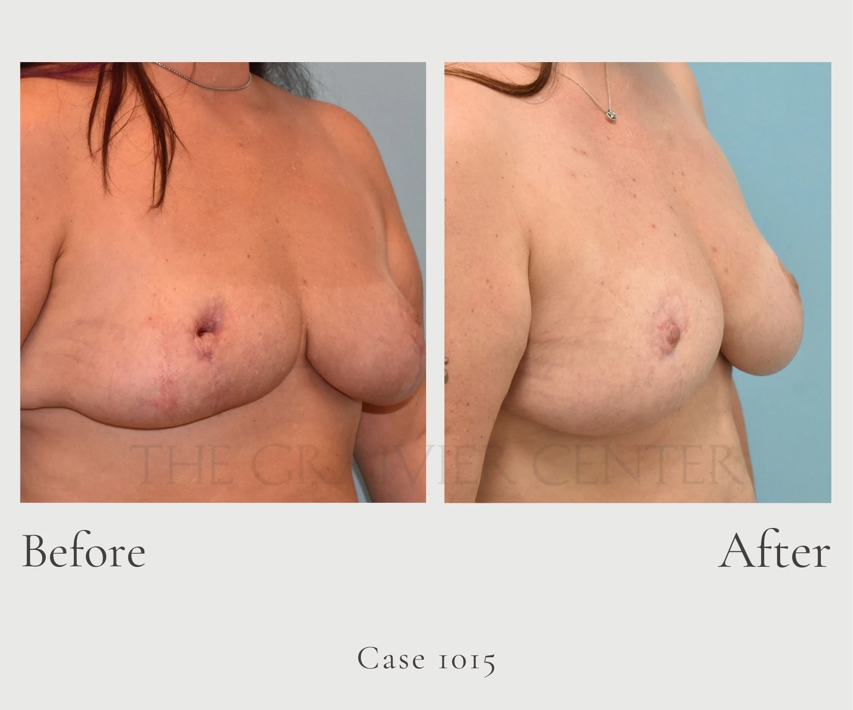 Case 1015 Breast Revision 4 months postop left