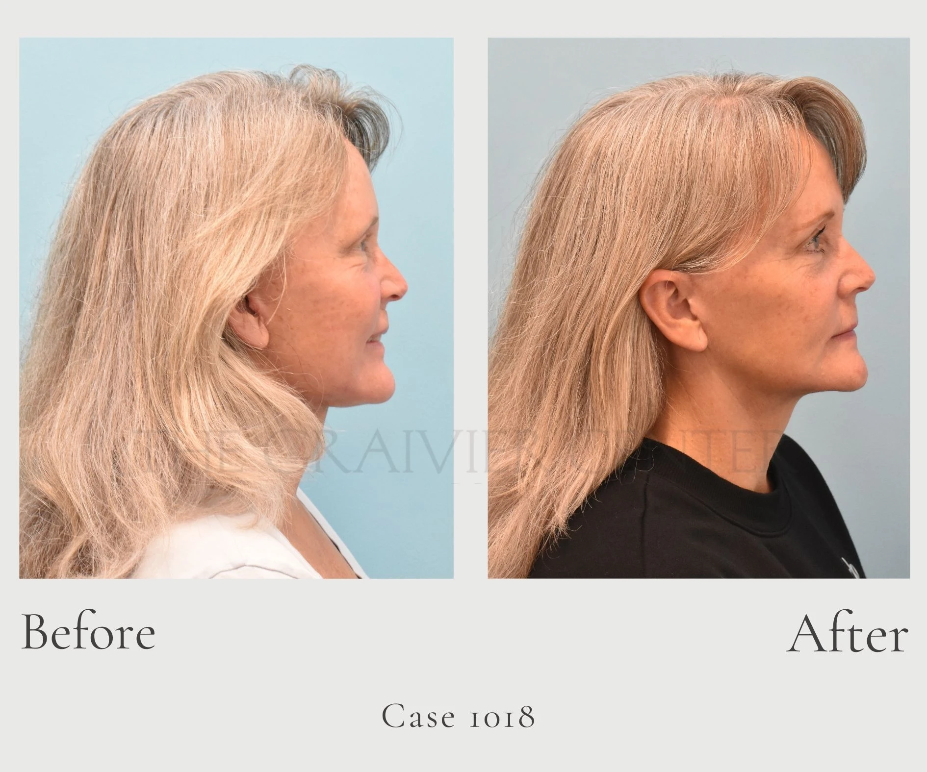 Case 1018 Face and Neck lift w fat grafting to the face with full face sciton laser profile