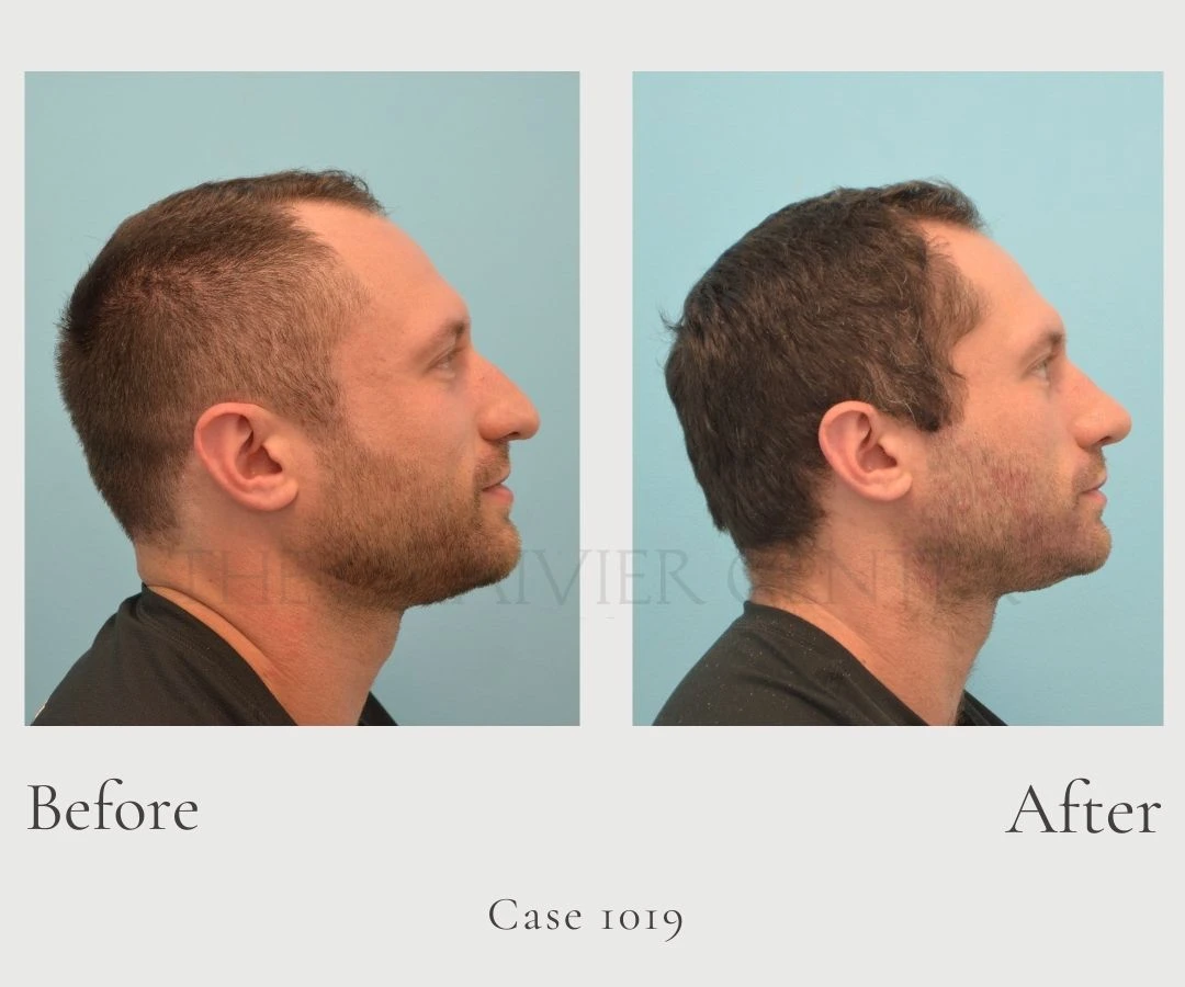 Case 1019 Open Rhinoplasty profile