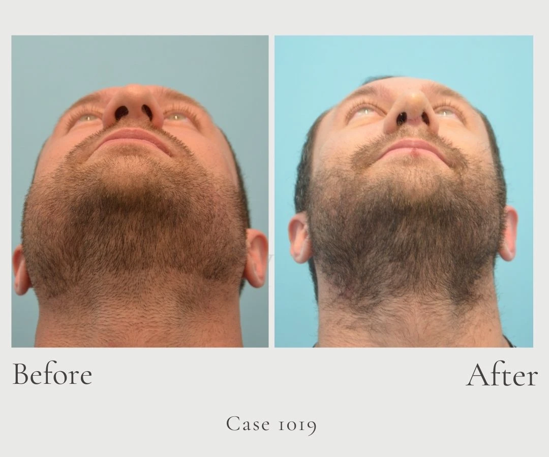 Case 1019 Open Rhinoplasty under