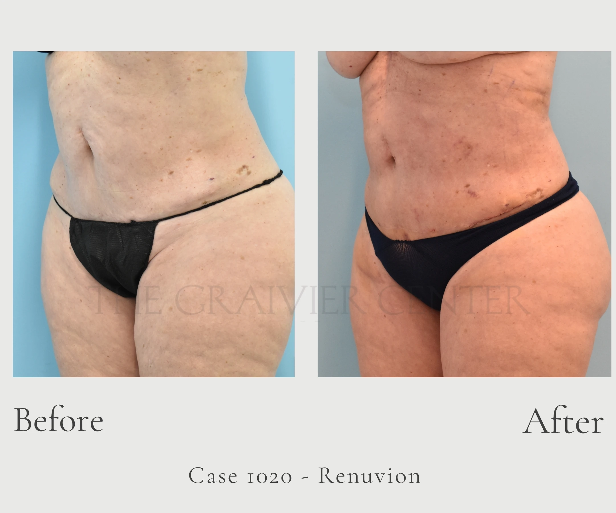Case 1020 Renuvion Jplasma Lipo diagonal