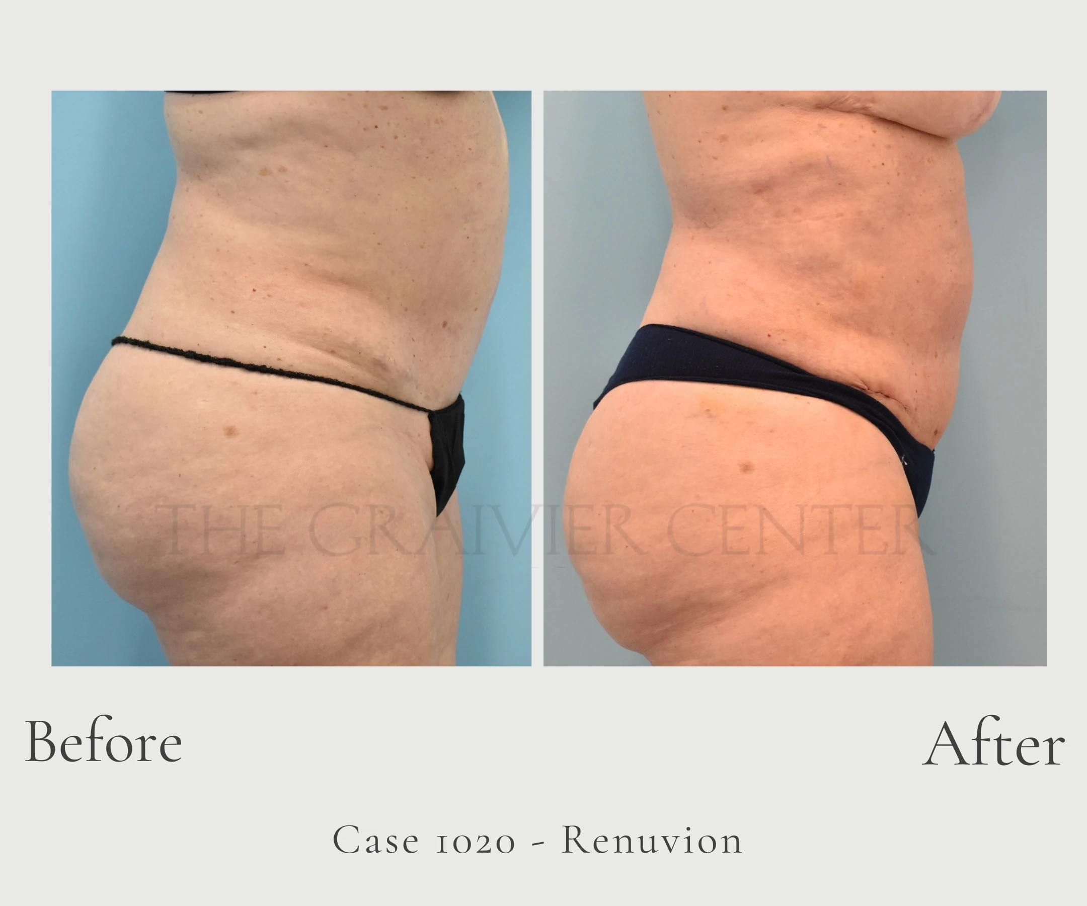 Case 1020 Renuvion Jplasma Lipo profile