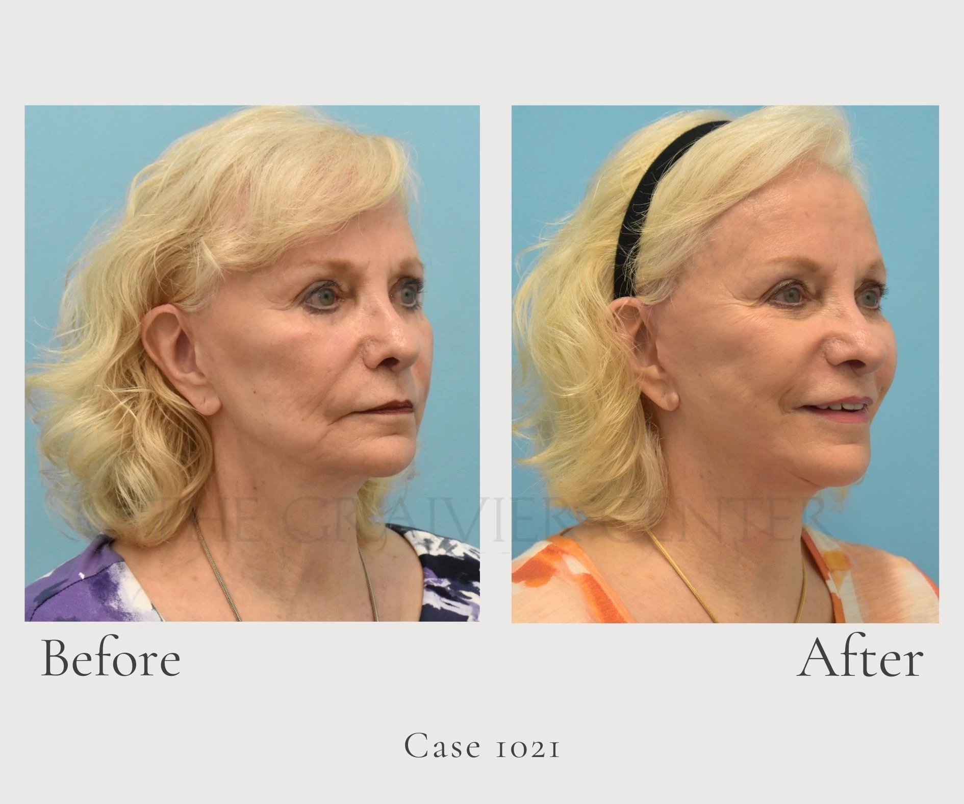Case 1021 Lower Face and Neck Lift with Buccal Fat removal profile