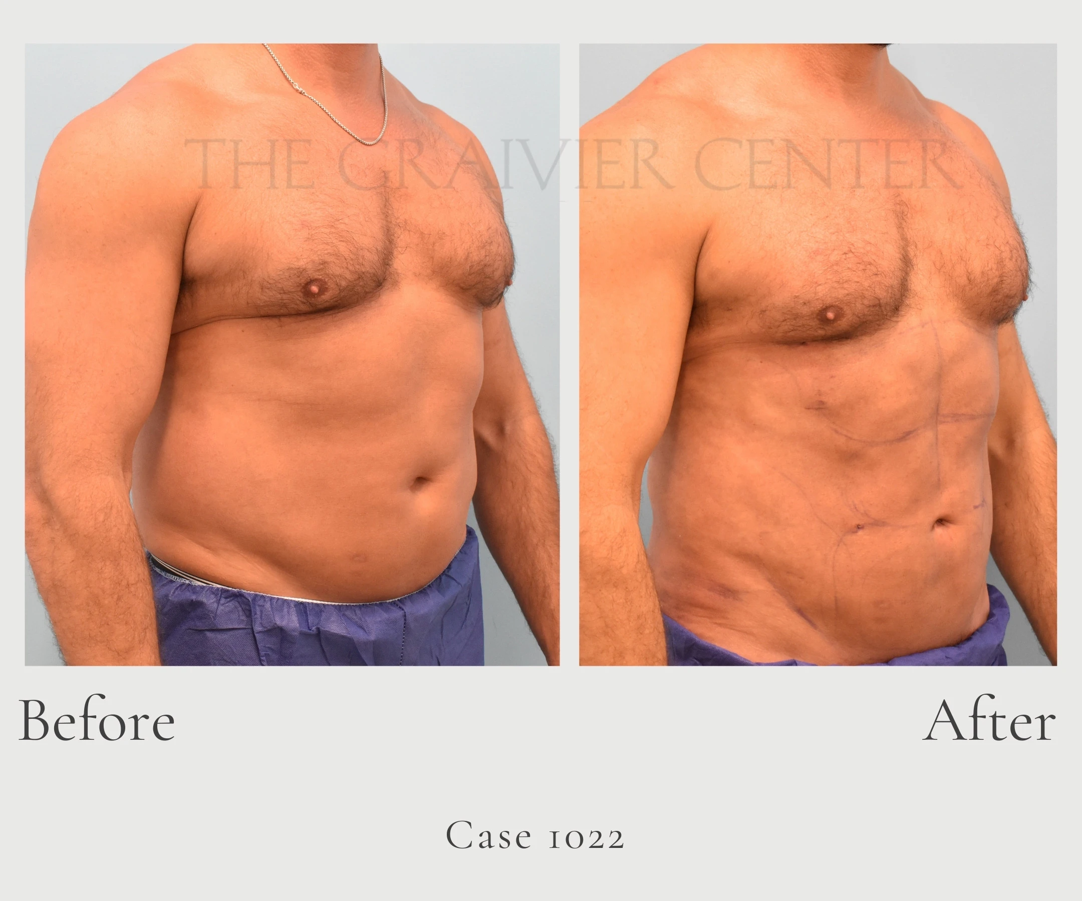 Case 1022 Laser Assisted lipo to abs, hips side view