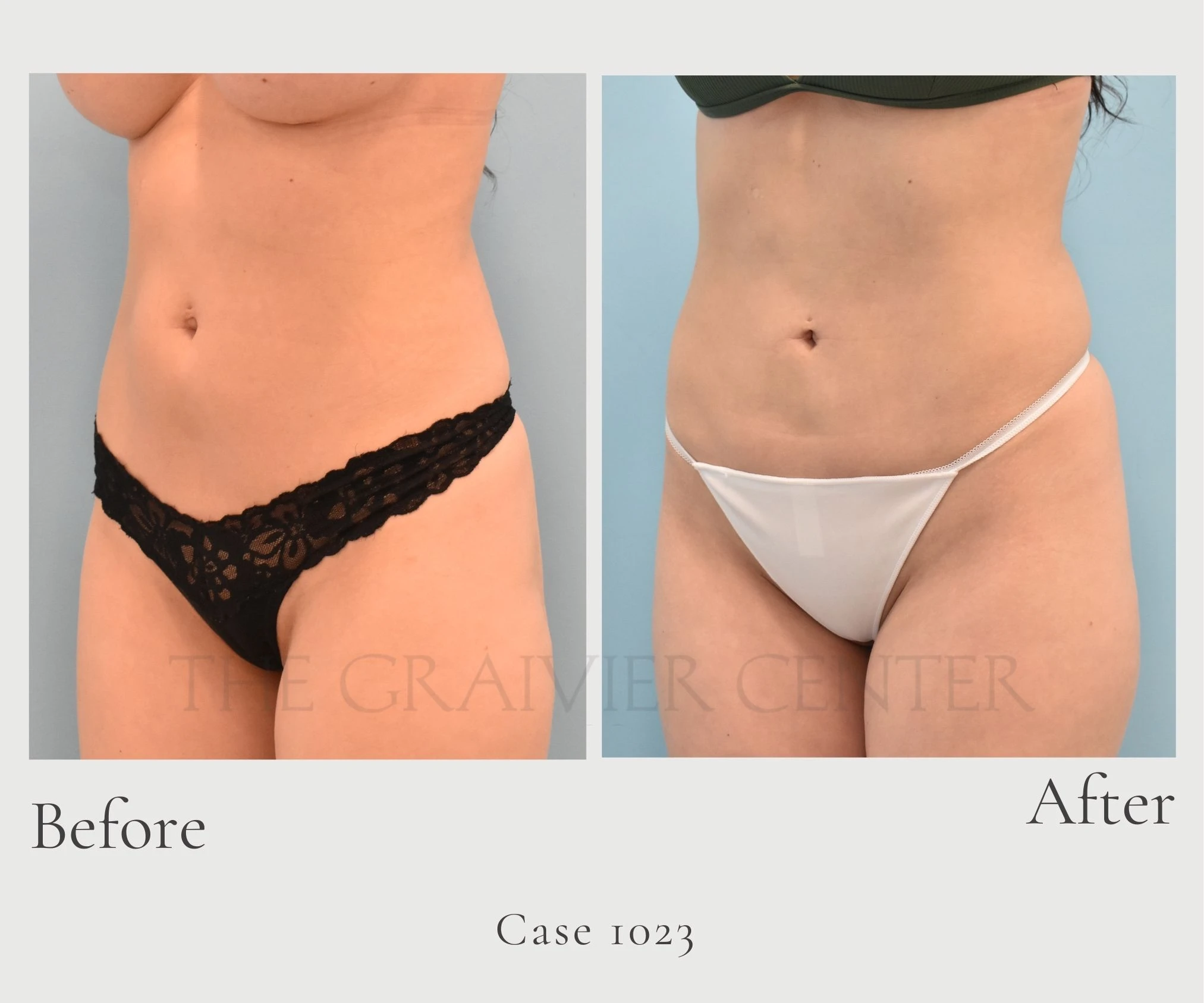 Case 1023 Lipo to tummy with umbilical hernia repair diagonal