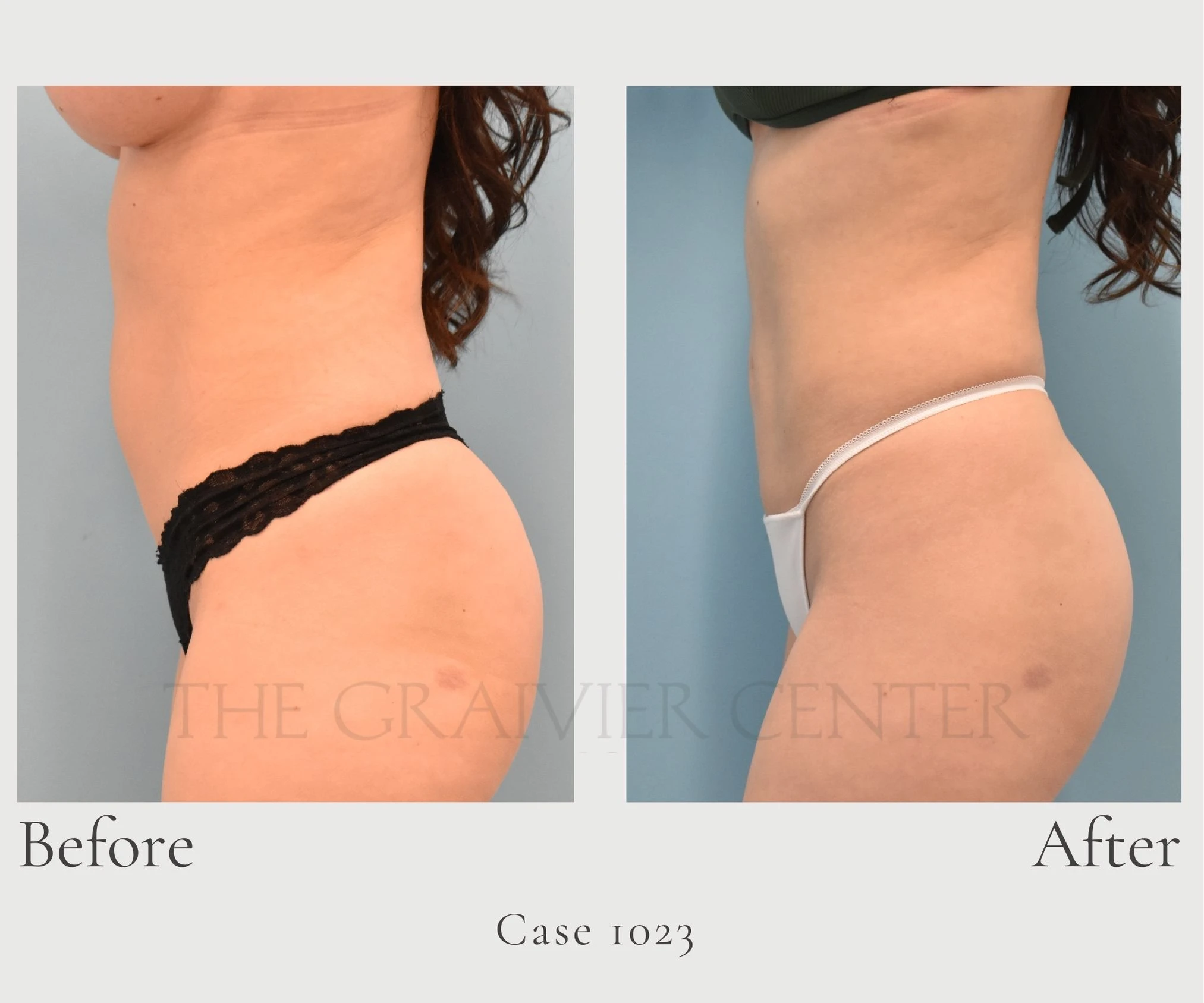 Case 1023 Lipo to tummy with umbilical hernia repair profile