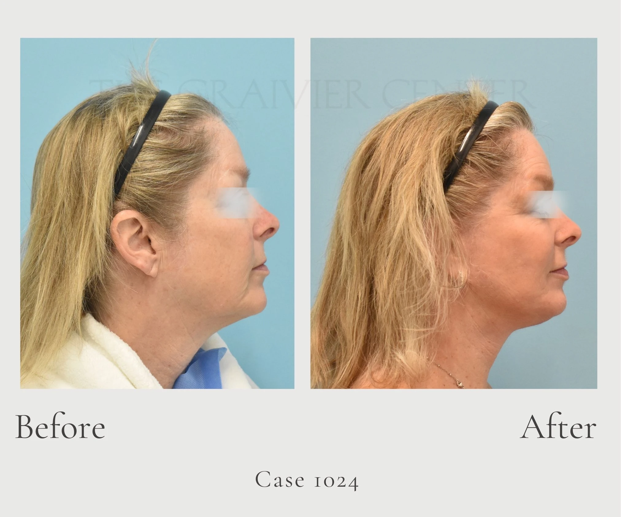 Case 1024 Face & Neck Lift with Full Face Laser Profile