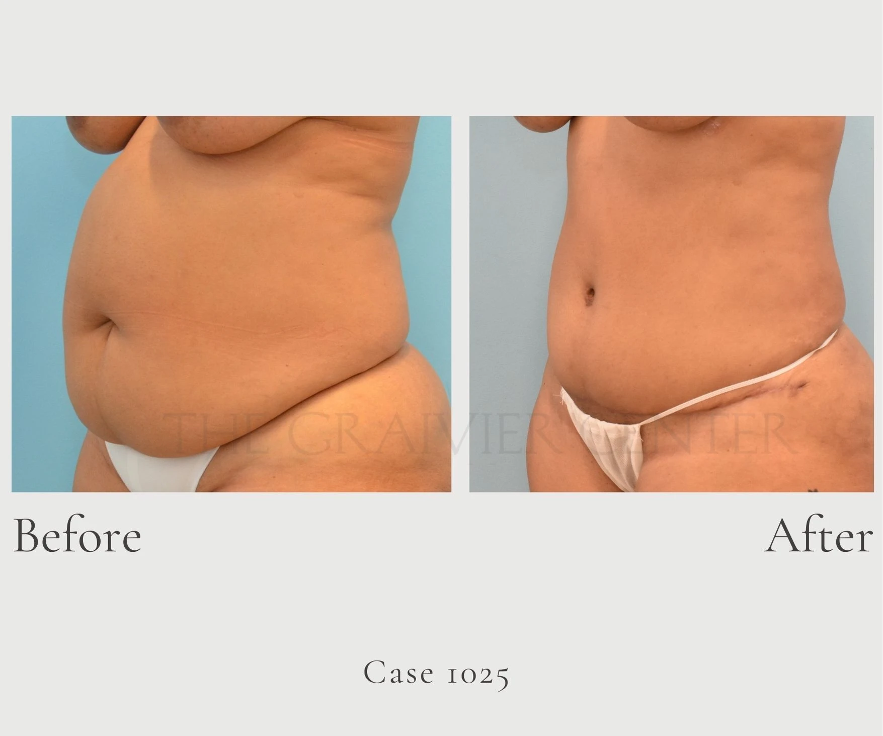 Case 1025 Abdominoplasty Tummy Tuck front diagonal