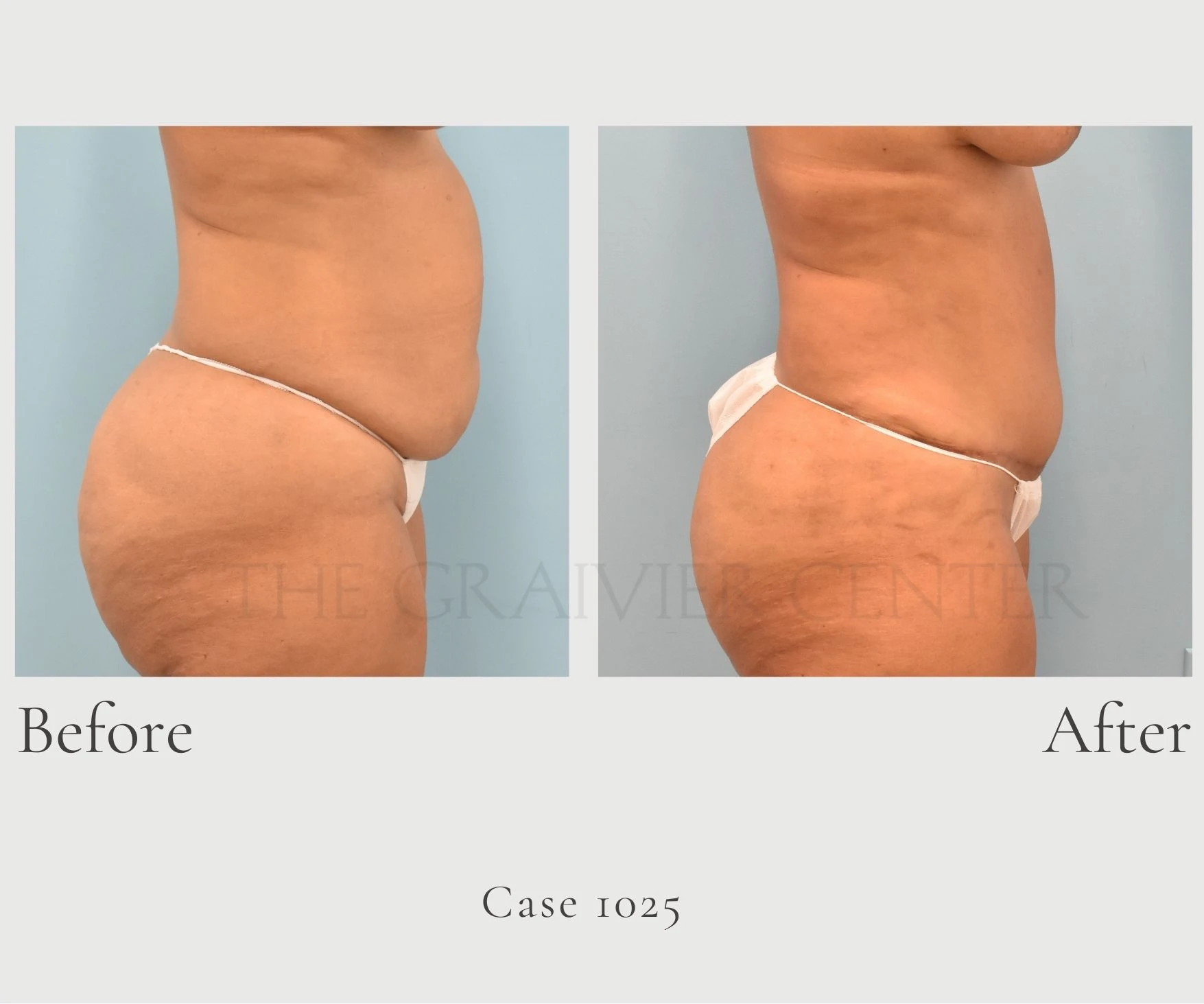 Case 1025 Abdominoplasty Tummy Tuck profile