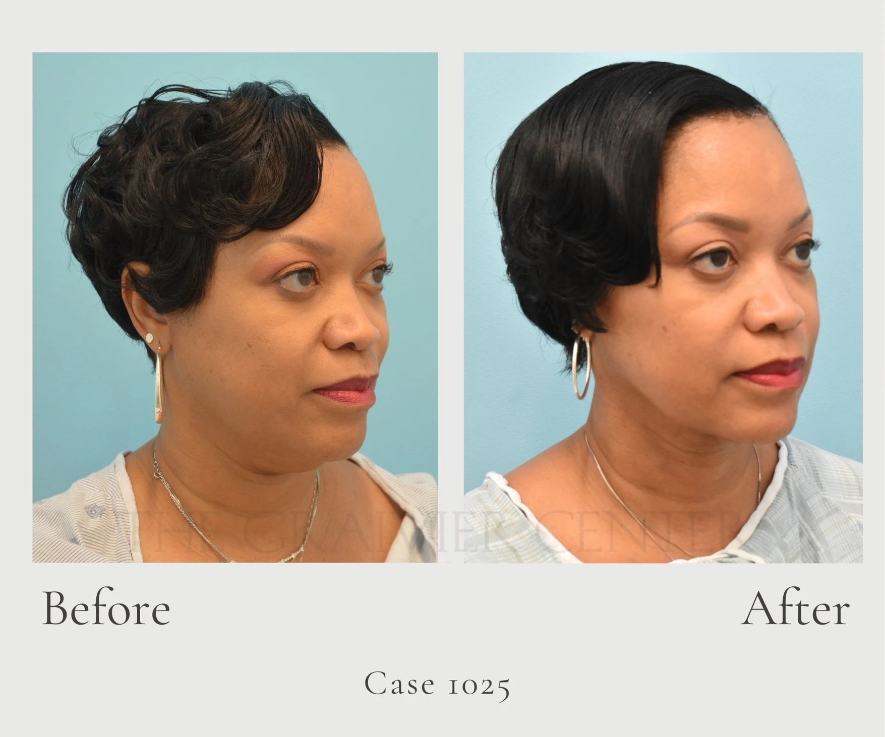 Case 1025 Contoure' Neck Lift with Lipo front diagonal