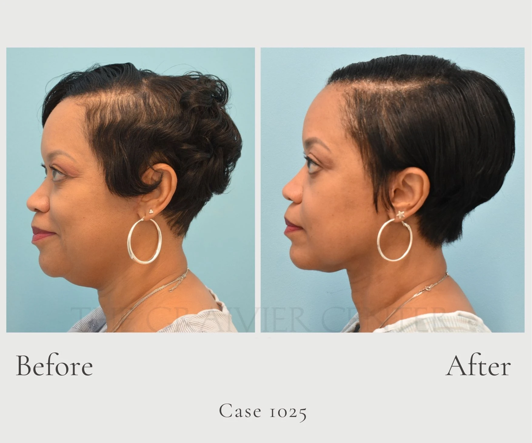 Case 1025 Contoure' Neck Lift with Lipo profile