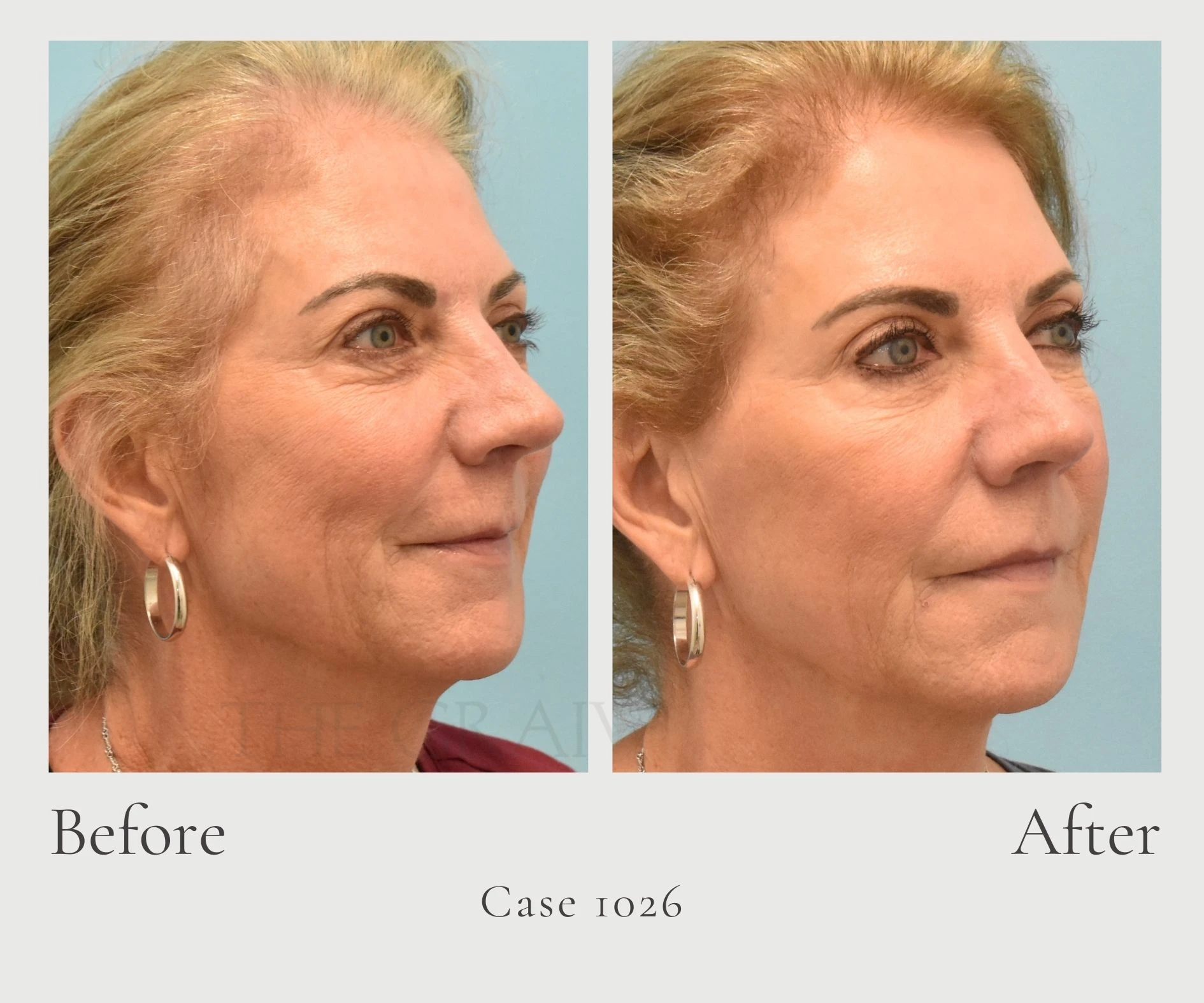 Case 1026 Upper Blepheroplasty eye lift side hill