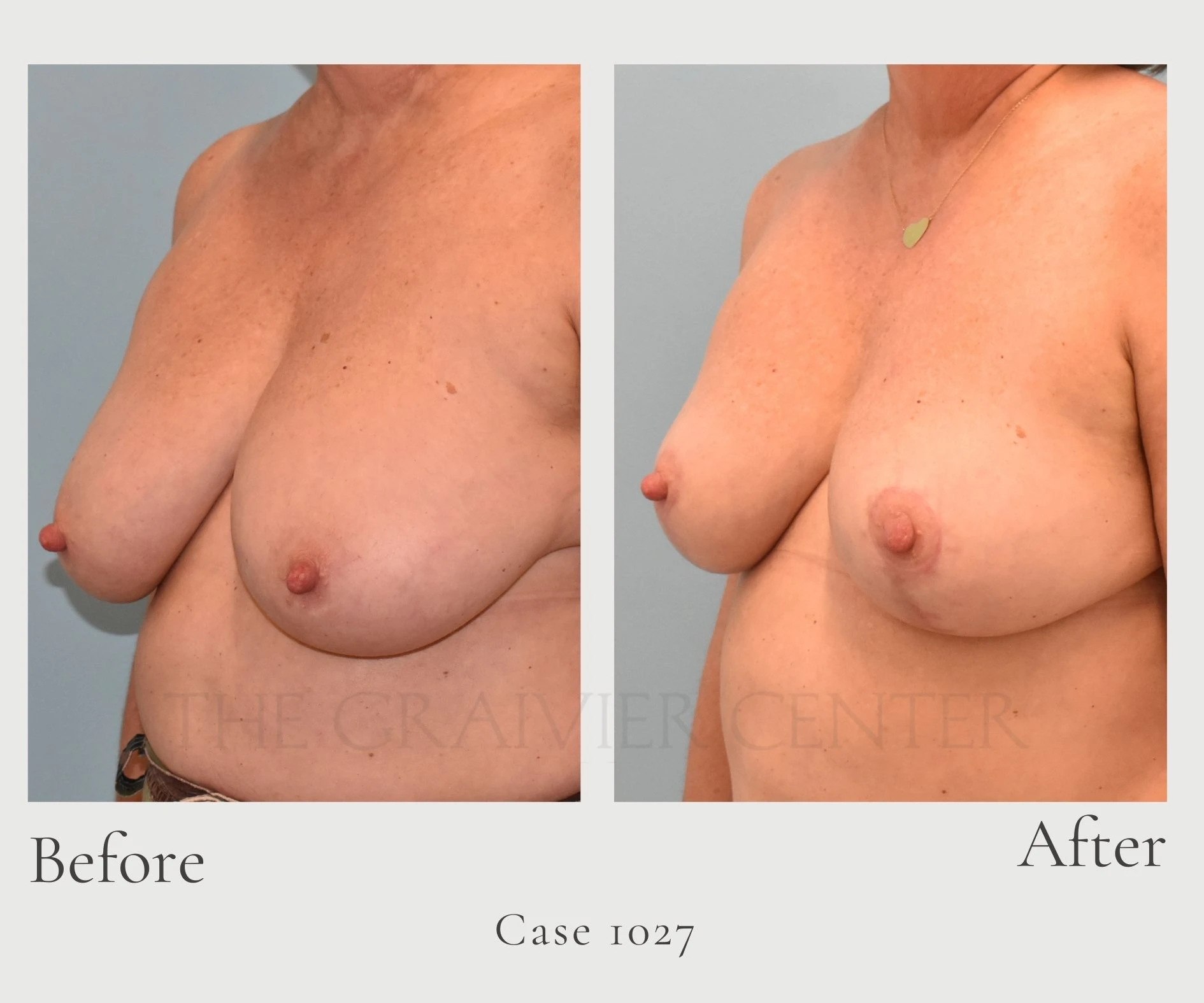 Case 1027 Breast Reduction with Lipo diagonal hill