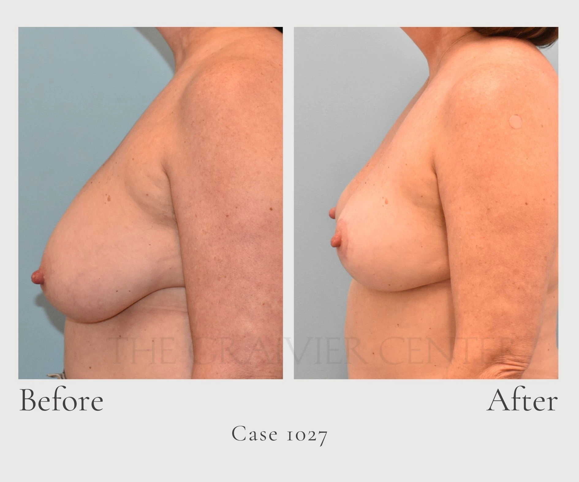 Case 1027 Breast Reduction with Lipo profile hill