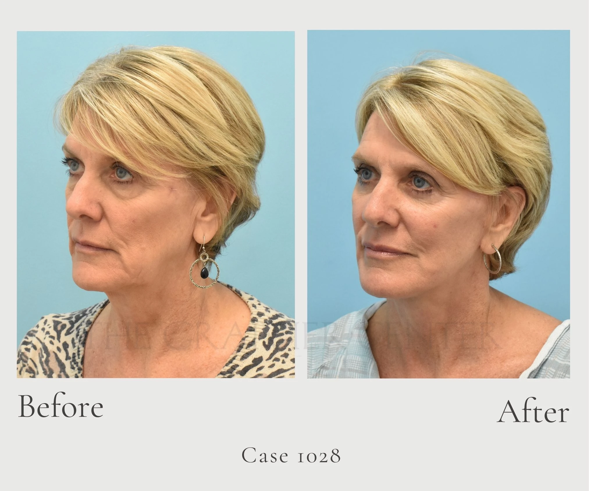 Case 1028 Face and Necklift with fat grafting to face laser lower bleph with canthopexy diagonal left G