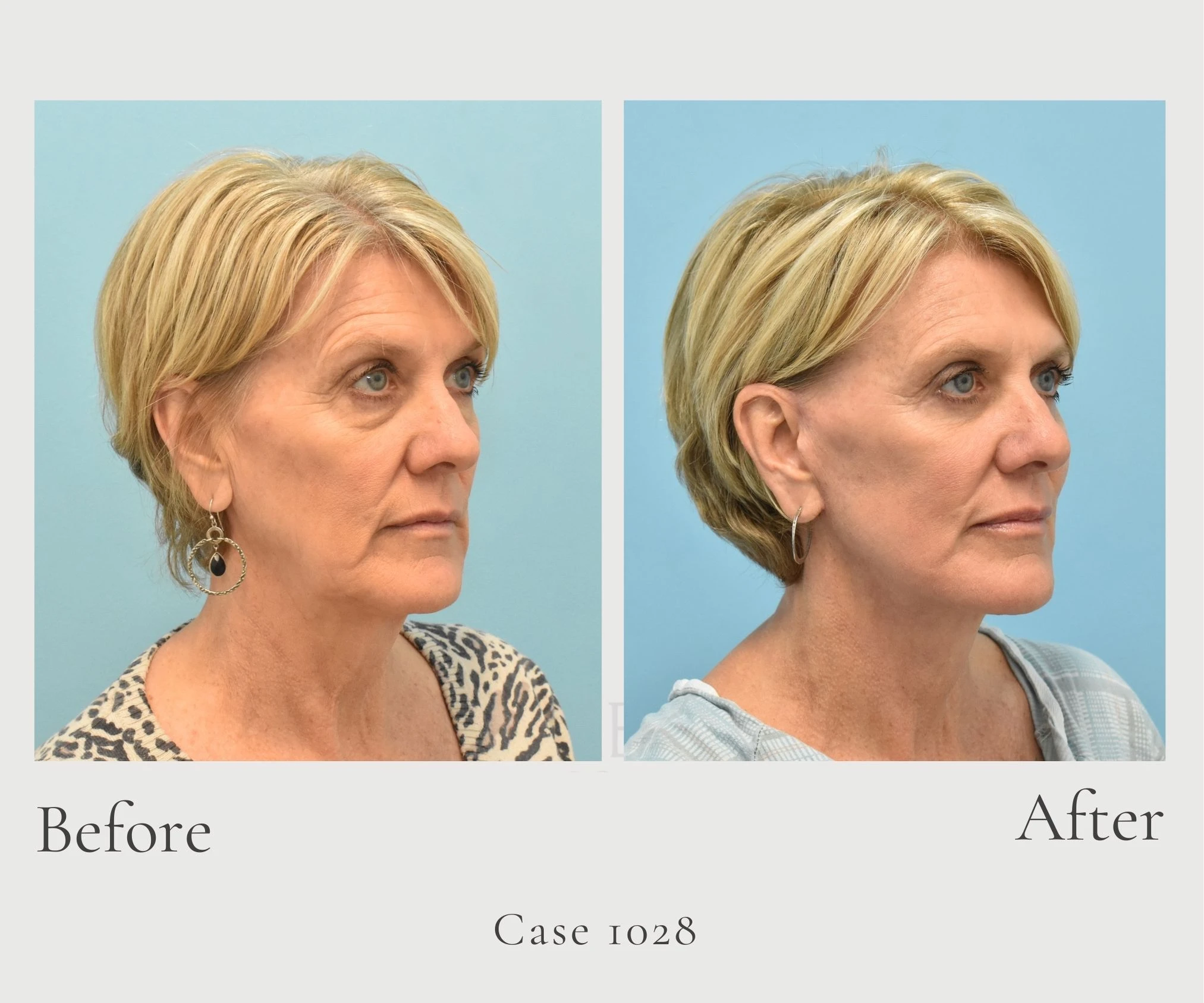 Case 1028 Face and Necklift with fat grafting to face laser lower bleph with canthopexy diagonal rt G