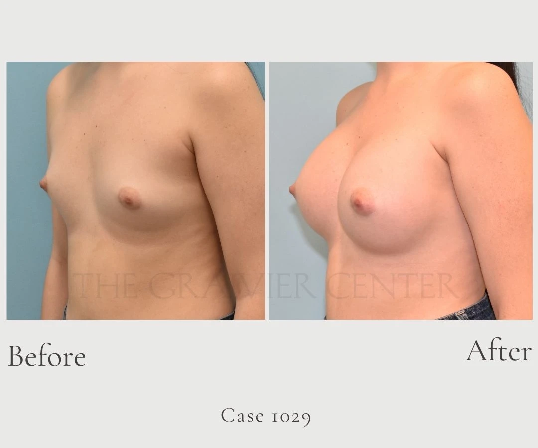 Case 1029 Breast Augmentation with boost gel implants diagonal left