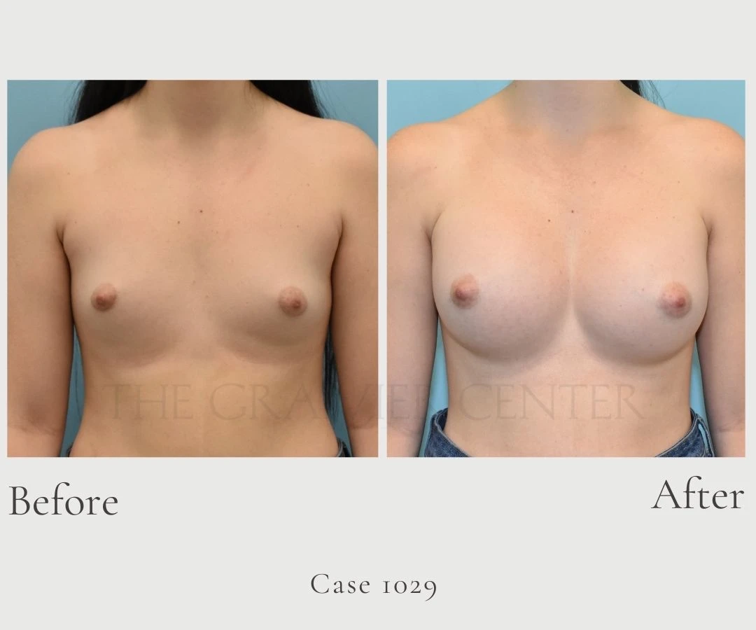 Case 1029 Breast Augmentation with boost gel implants front