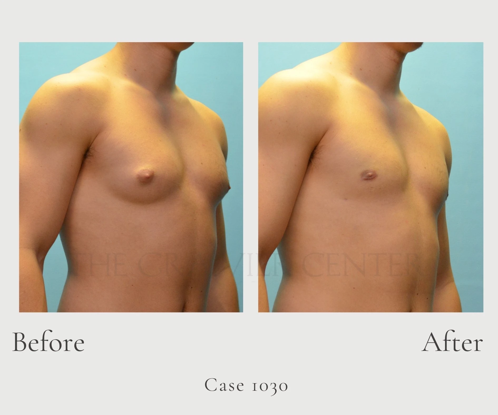 Case 1030 Gynecomastic Male Breast Reduction right (2)