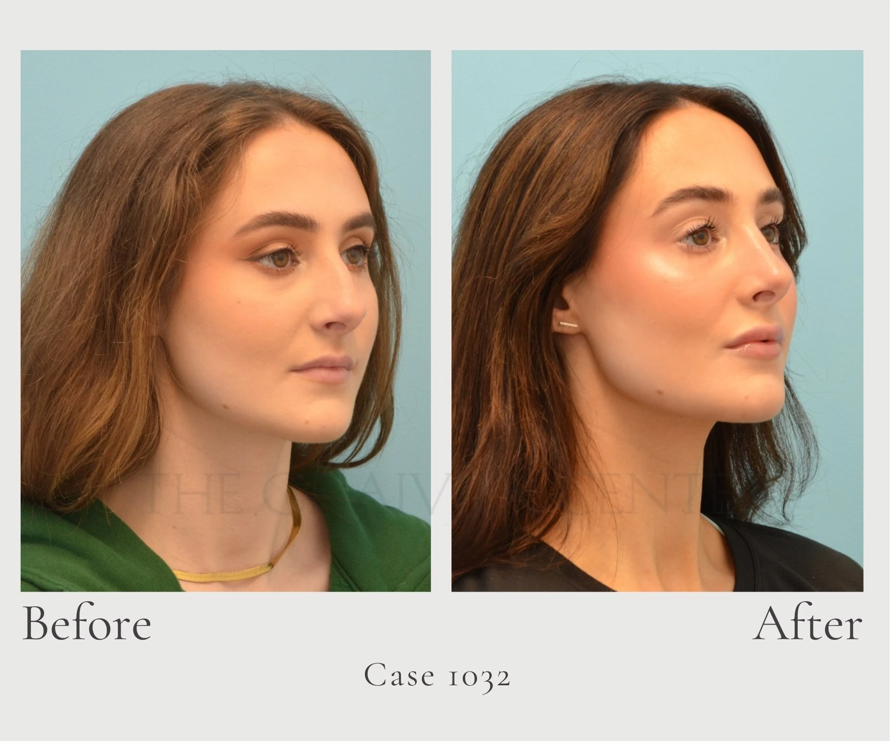 Case 1032 Closed Rhino Dr. Hill diagonal right