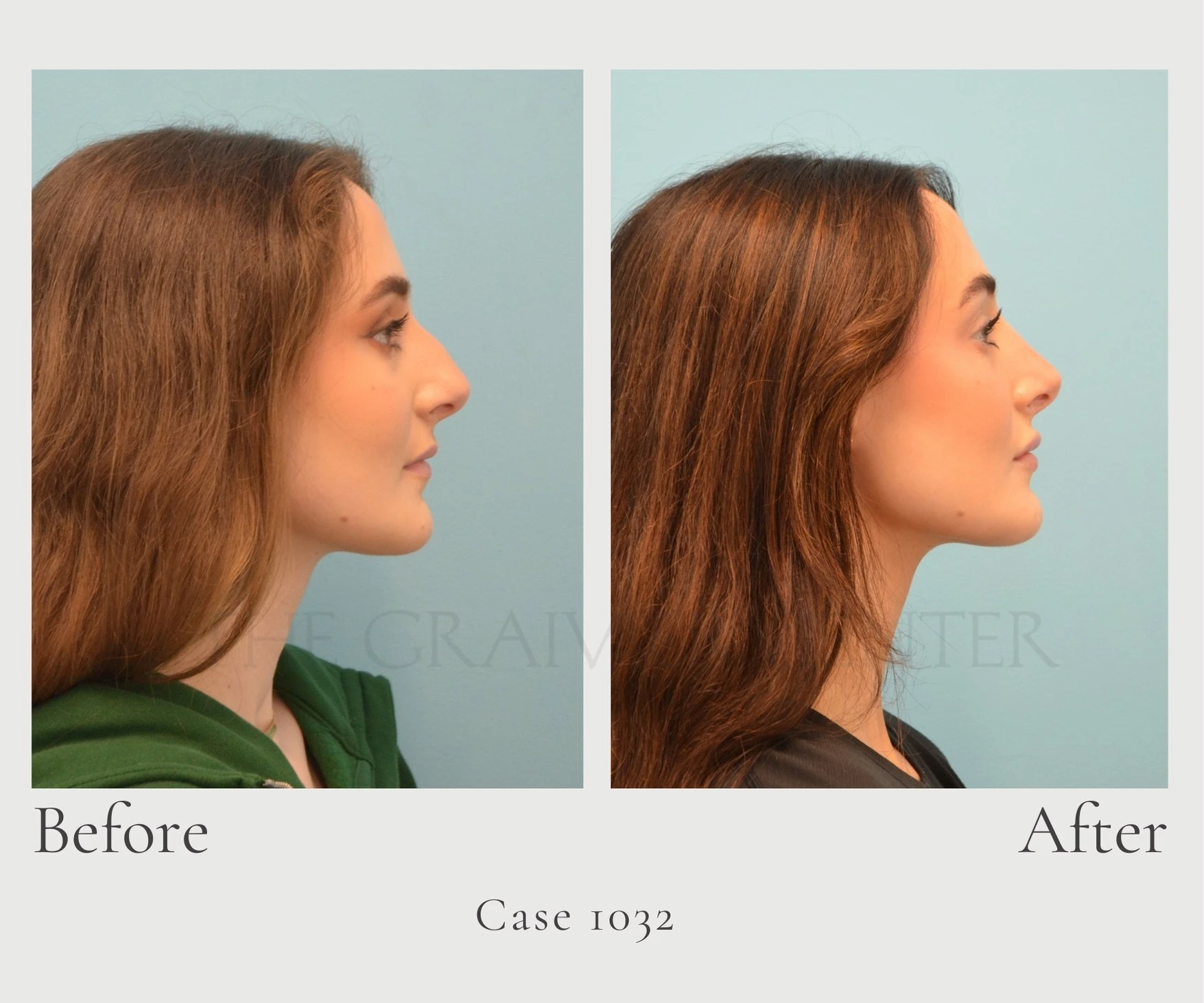 Case 1032 Closed Rhino Dr. Hill profie right