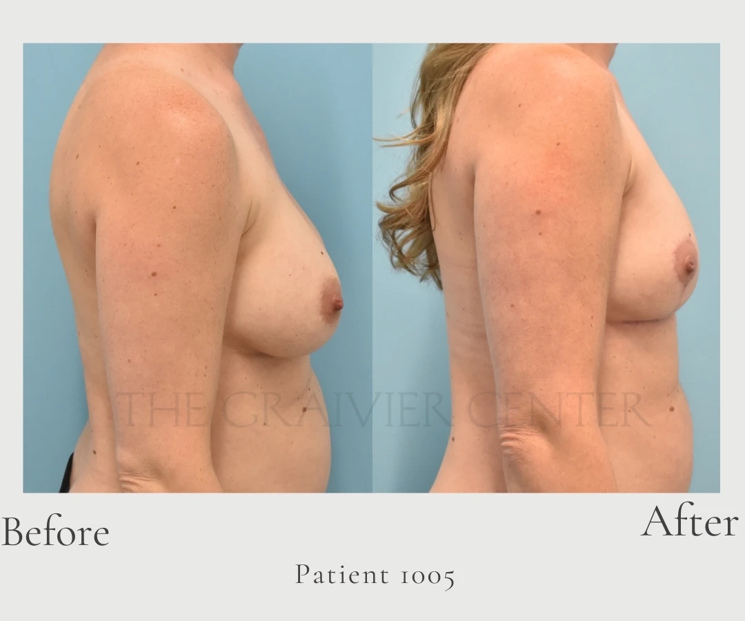 Patient 1005 implant removal, capsulectomy, bilateral mastopexy & fat grafting left