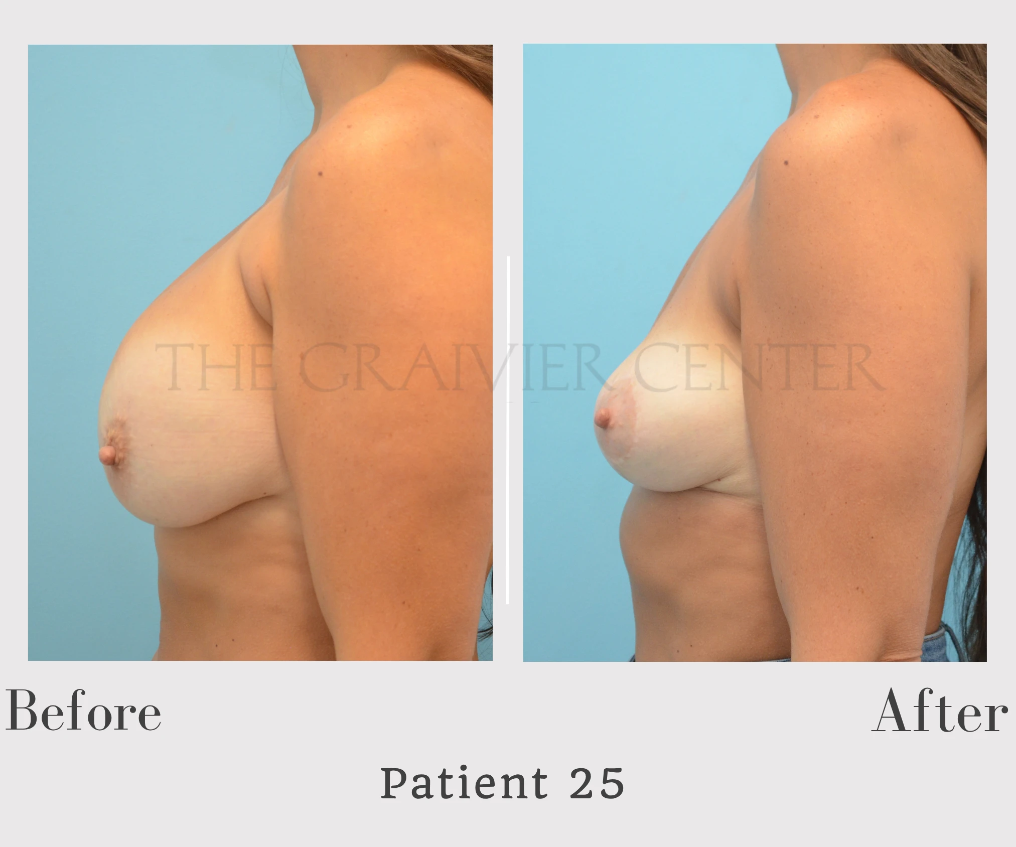 Patient 25 Breast Implant Removal Explant Capsulectomy mastopexy Right
