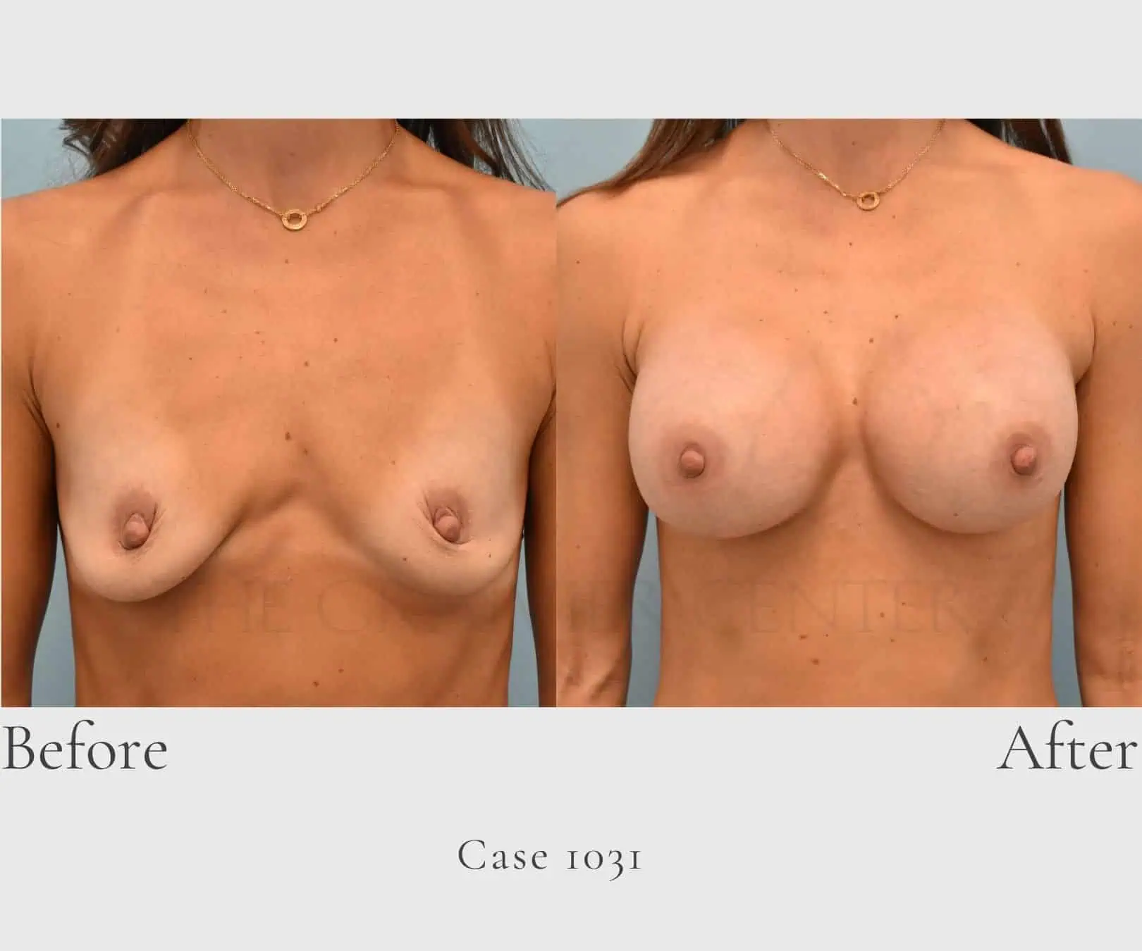 Case 1031 Breast implant augmentation 1