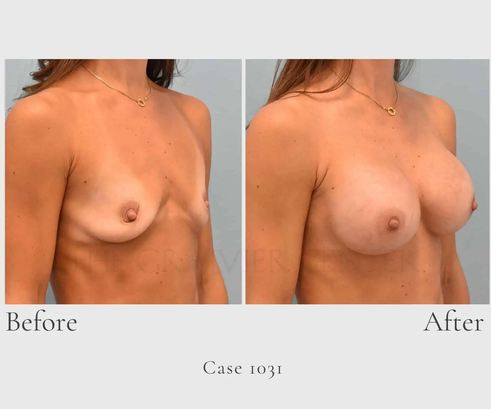 Case 1031 Breast implant augmentation 2