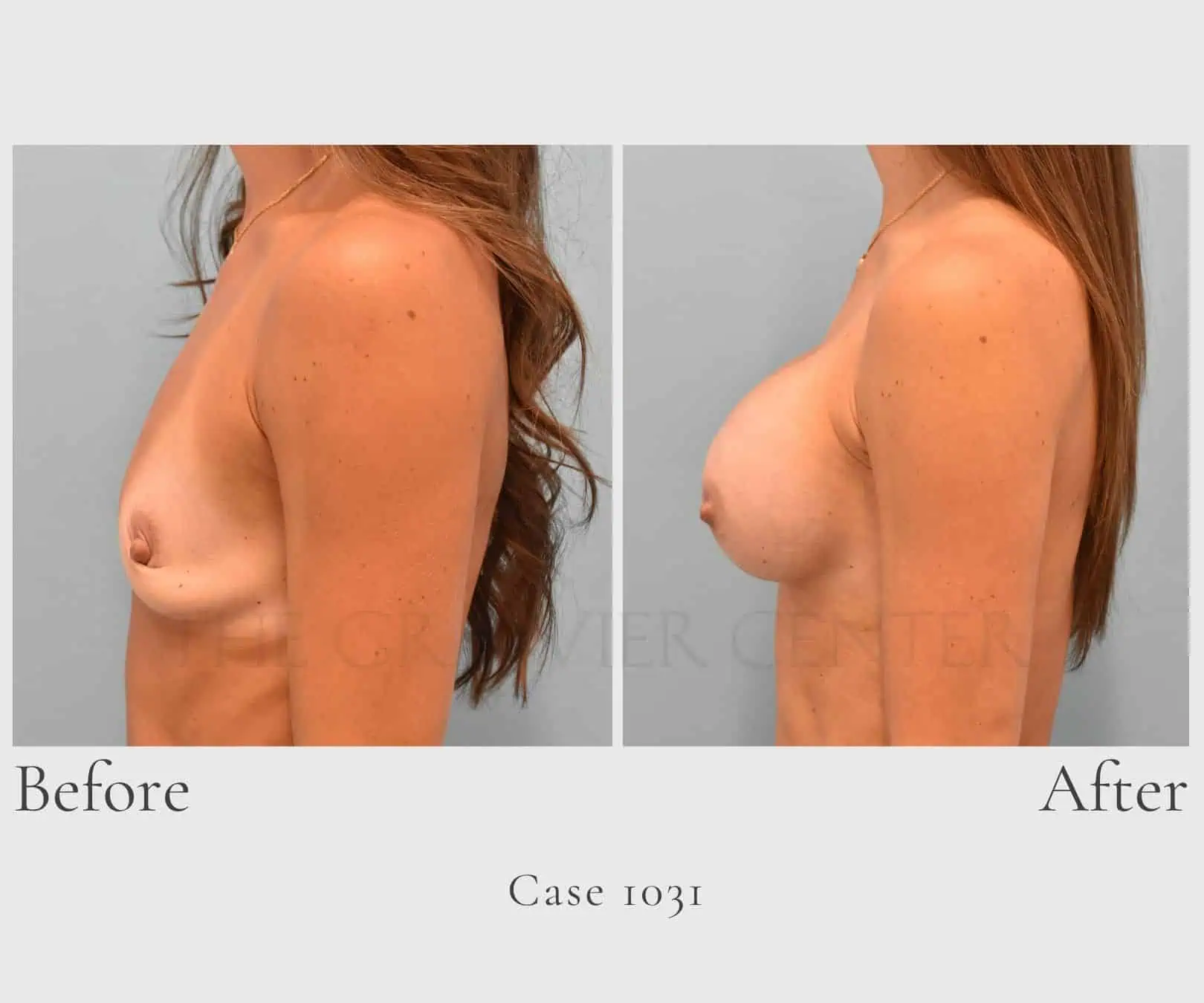 Case 1031 Breast implant augmentation 3