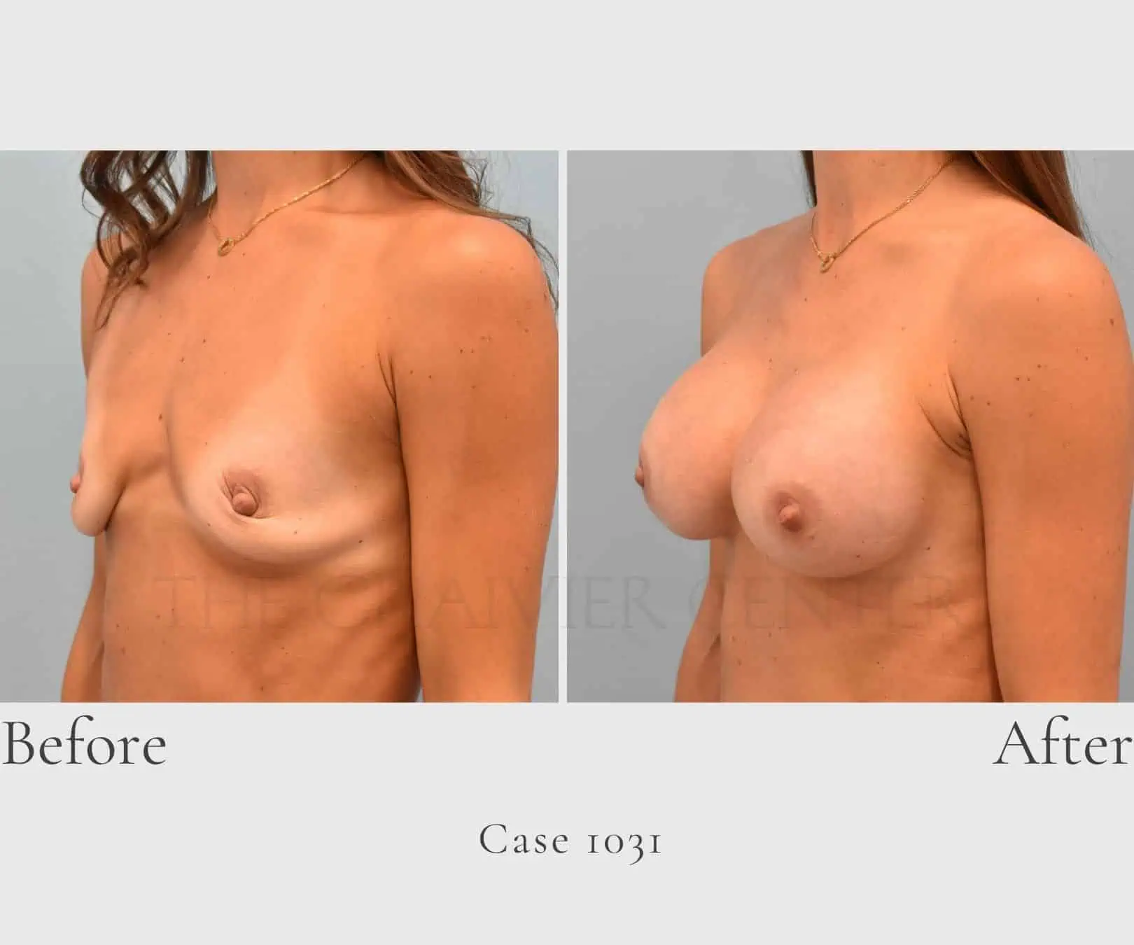 Case 1031 Breast implant augmentation 4