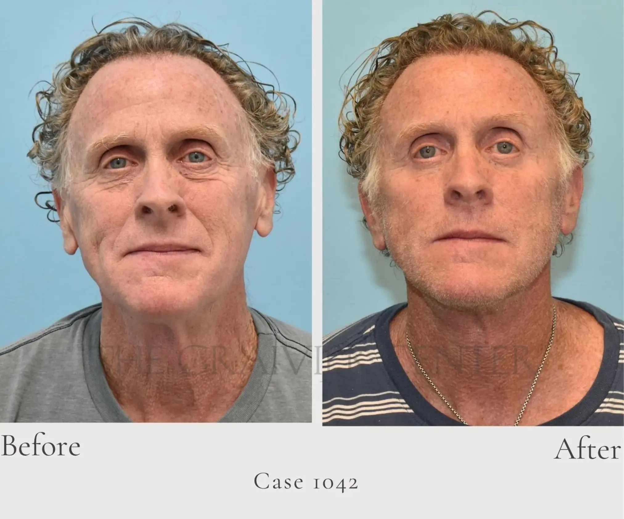Case 1042 Facelift and Lower Eye lid 1