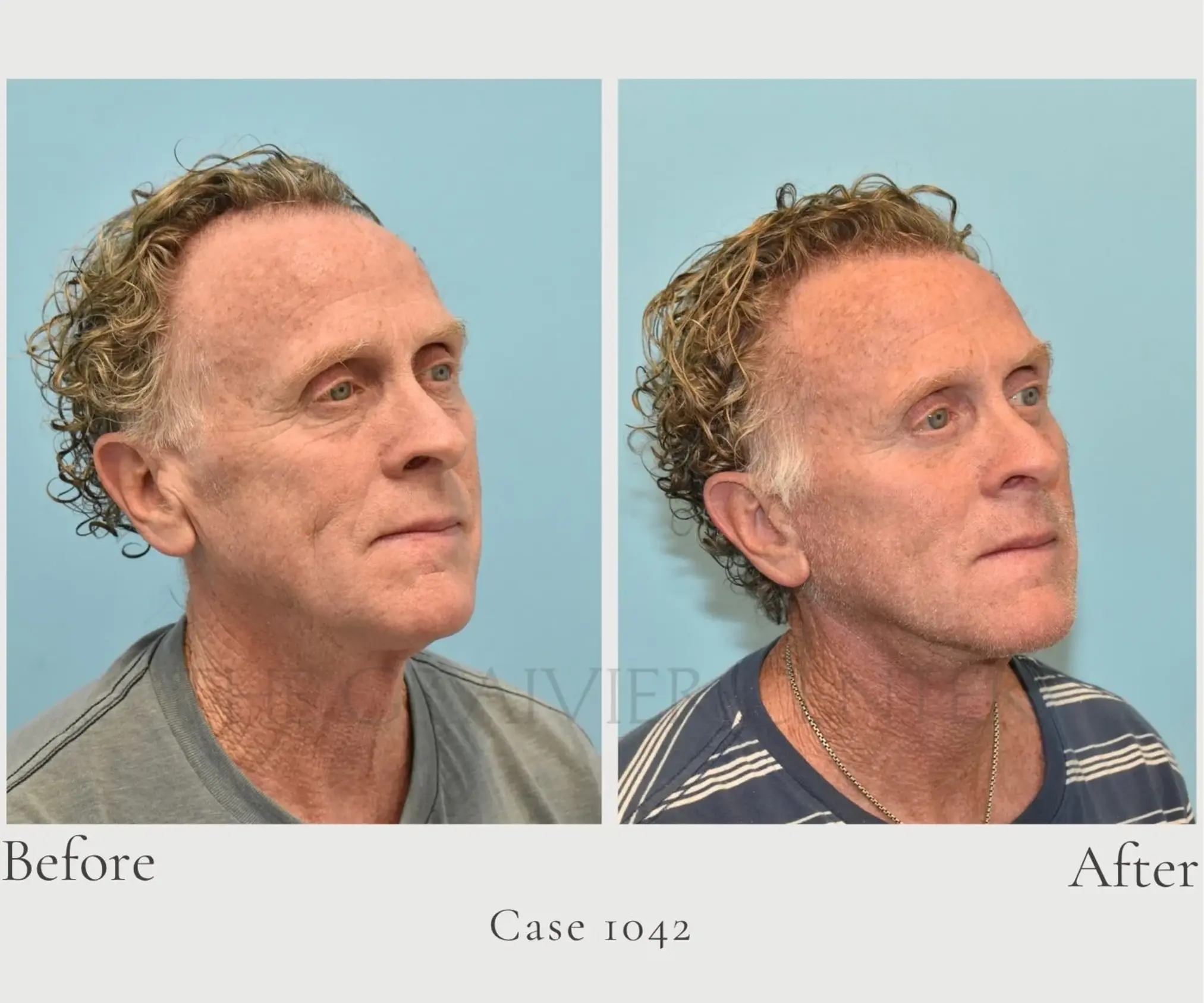 Case 1042 Facelift and Lower Eye lid 2