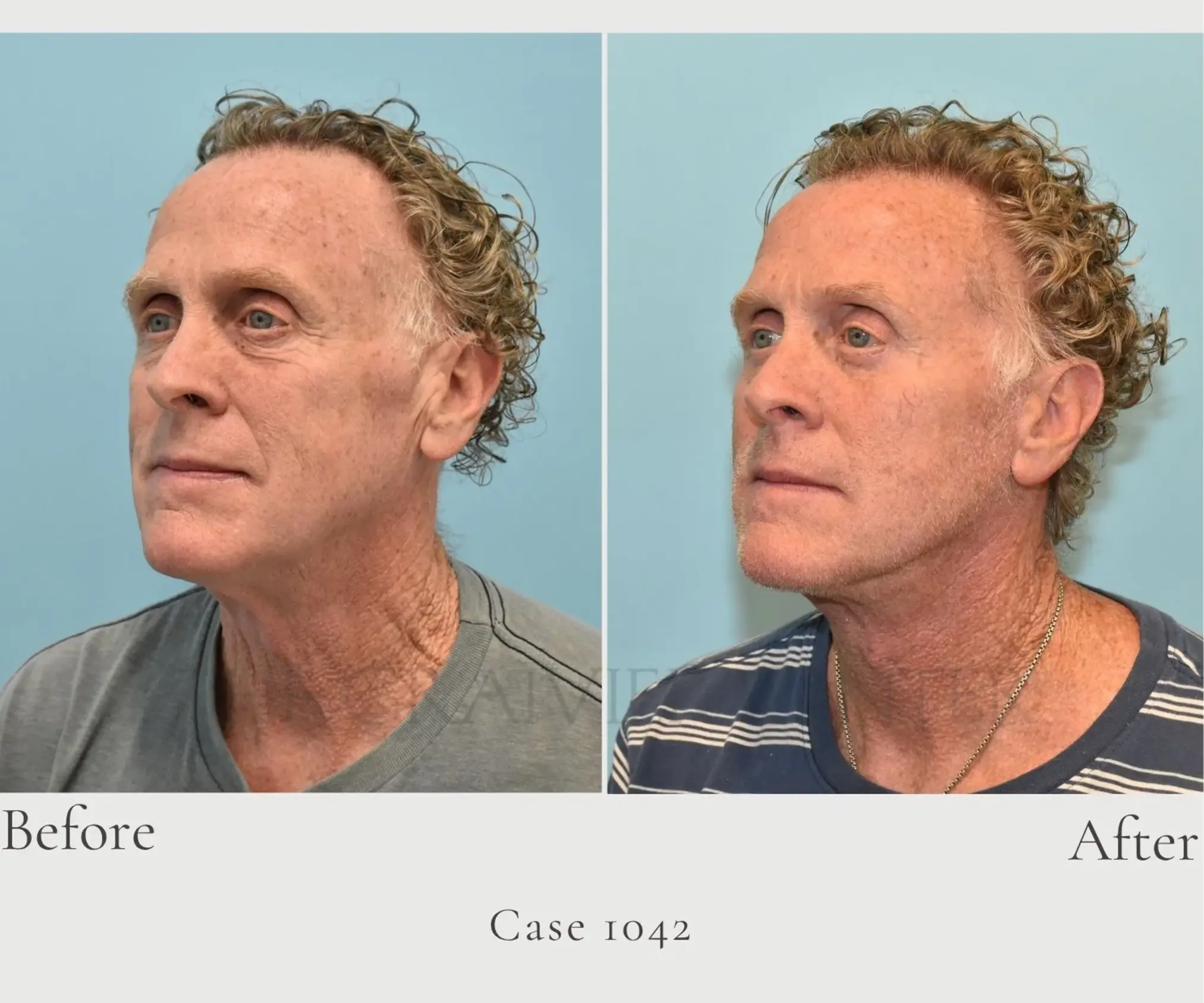 Case 1042 Facelift and Lower Eye lid 3